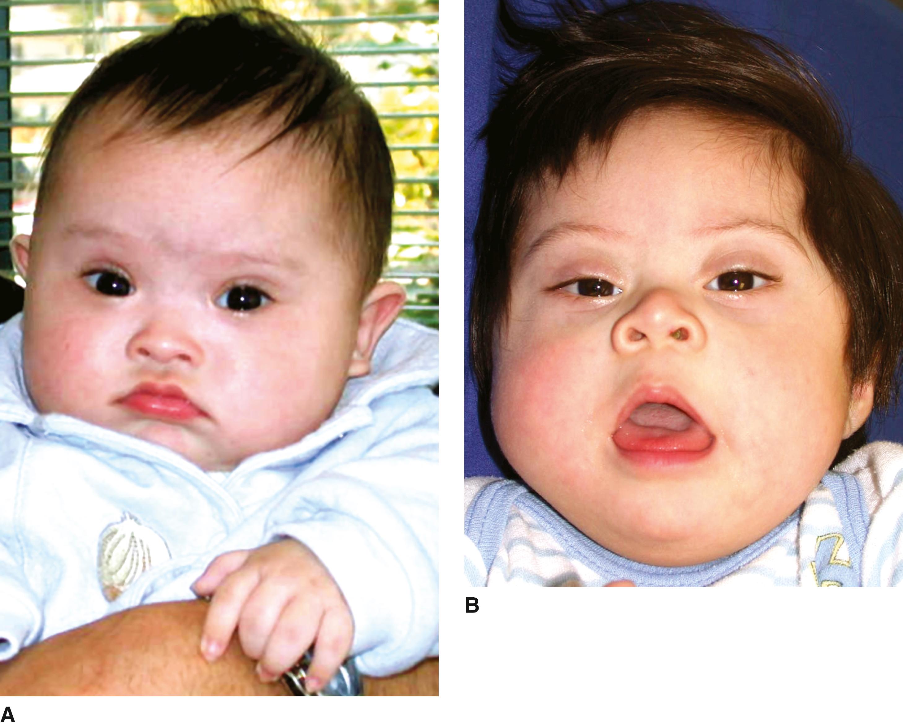 FIGURE 2, A and B, Upslanting palpebral fissures. Low nasal bridge with upturned nares.