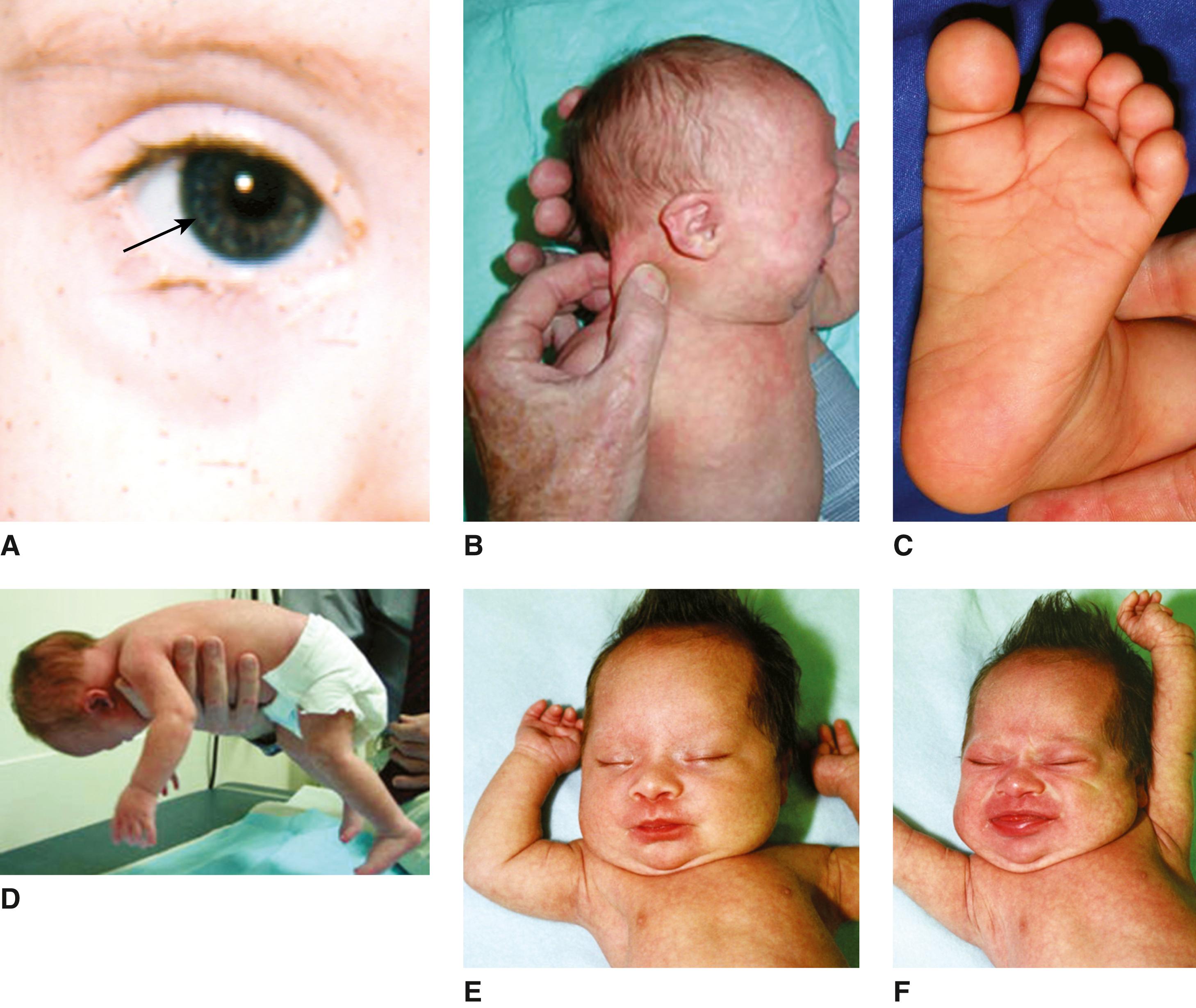 FIGURE 3, A, Brushfield spots. B, Loose nuchal skin. C, Wide space between toes 1 and 2. D, Poor tone. E and F, Accentuation of typical face when crying.