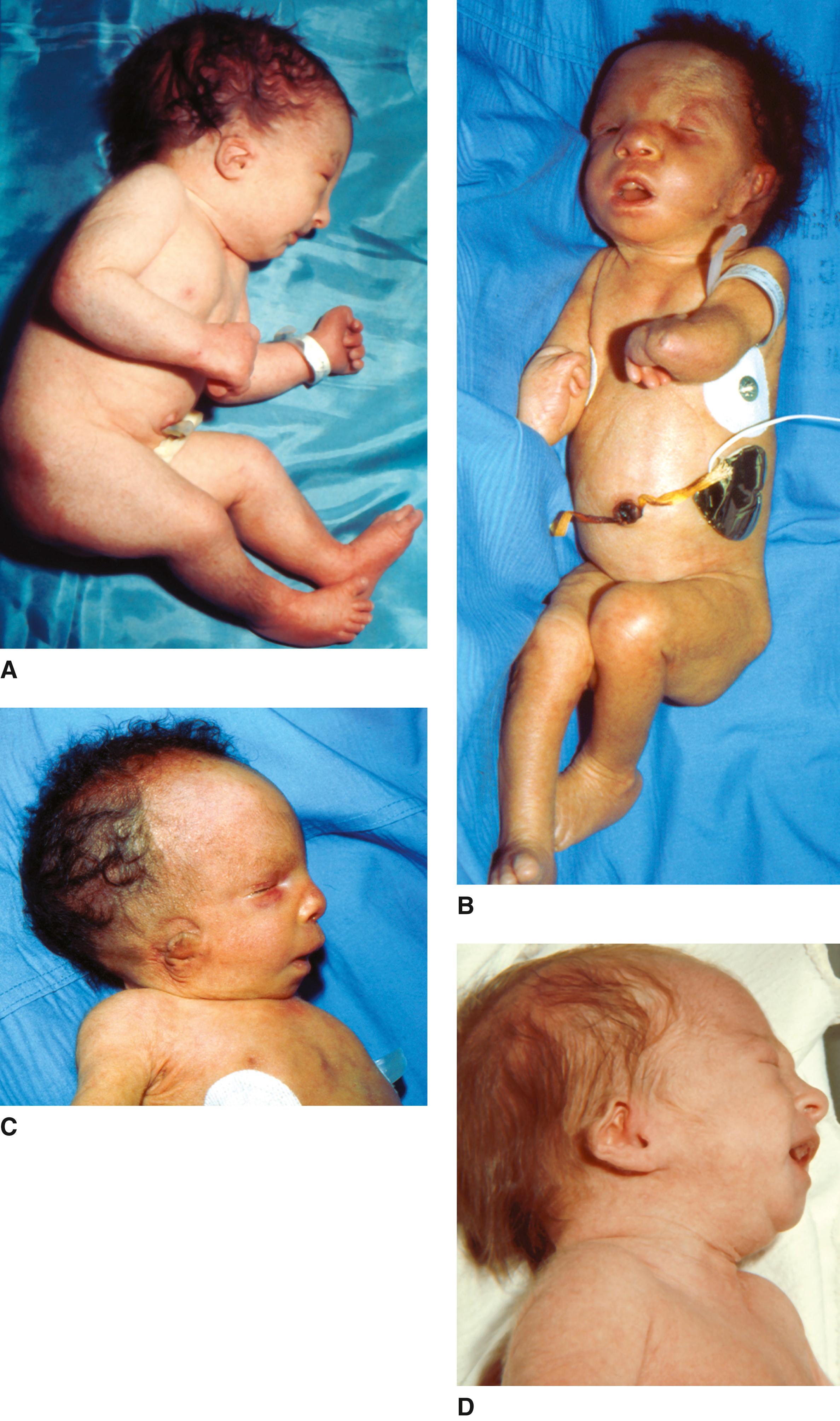 FIGURE 1, Trisomy 18 syndrome.