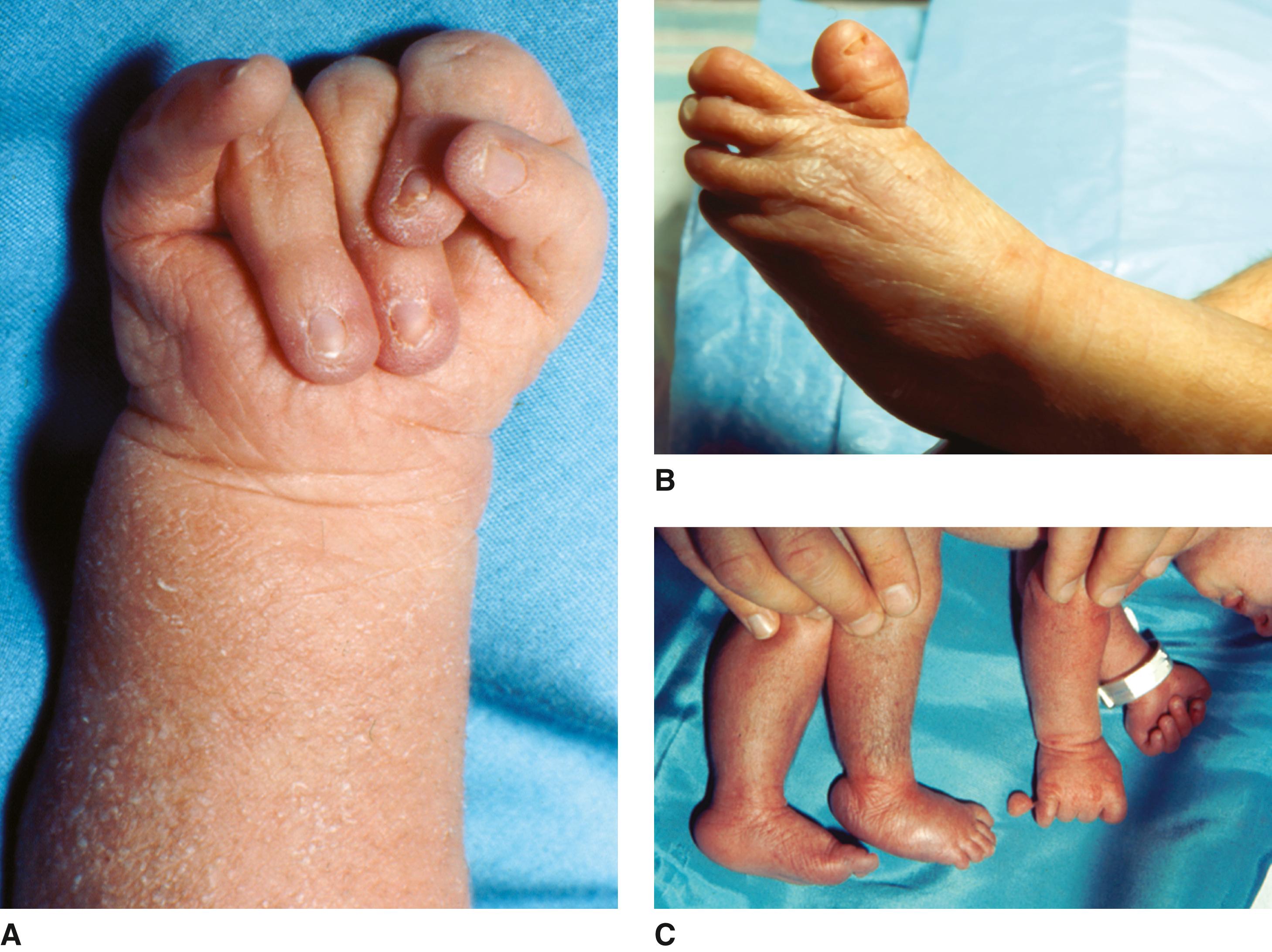 FIGURE 2, A, Clenched hand with index finger overlying third; hypoplasia of fingernails. B, Dorsiflexed short hallux. C, Prominent calcaneus and postaxial polydactyly.