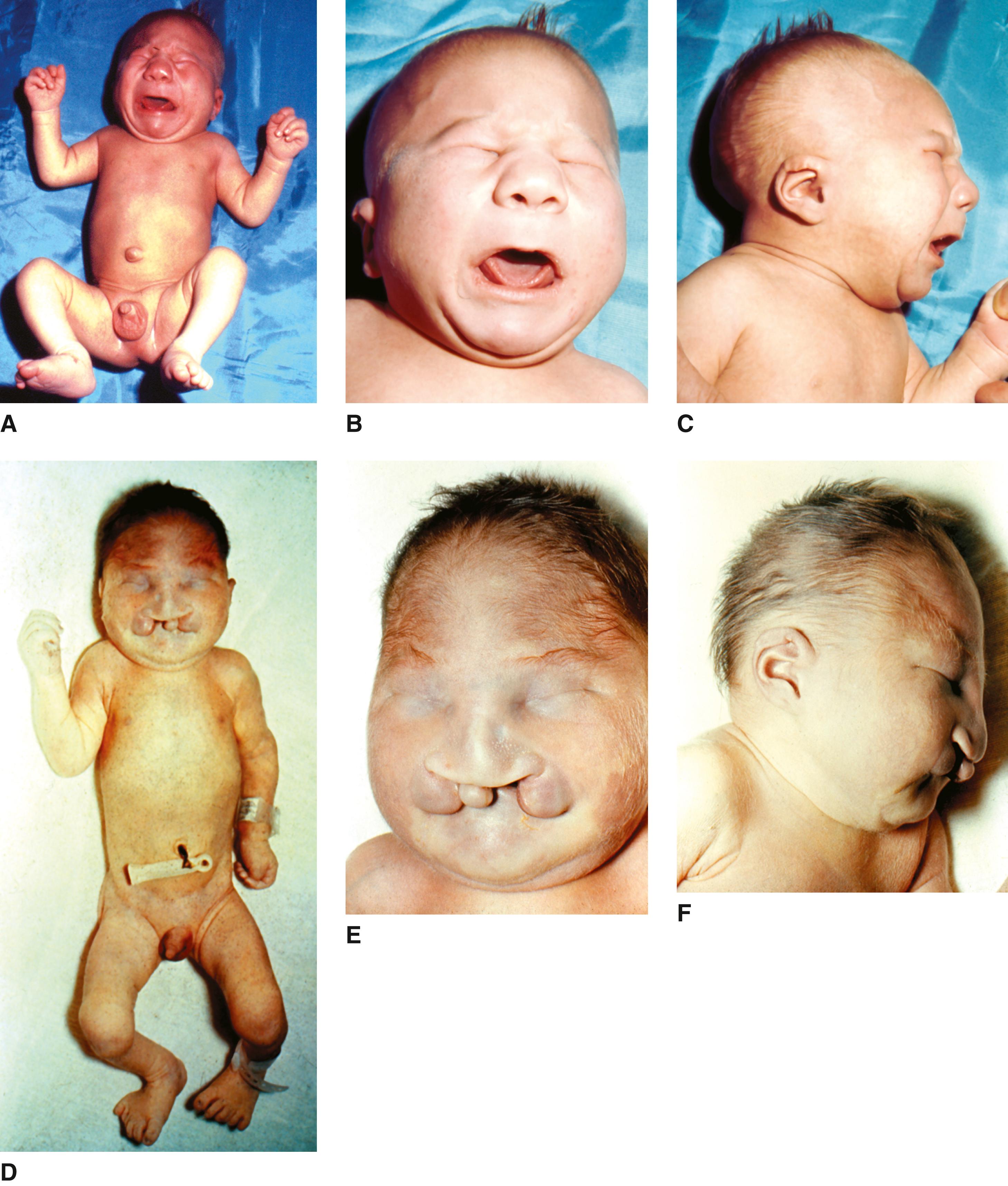 FIGURE 1, A–F, Two newborn children with trisomy 13 syndrome. Note sloping forehead with variable defect in facial development.