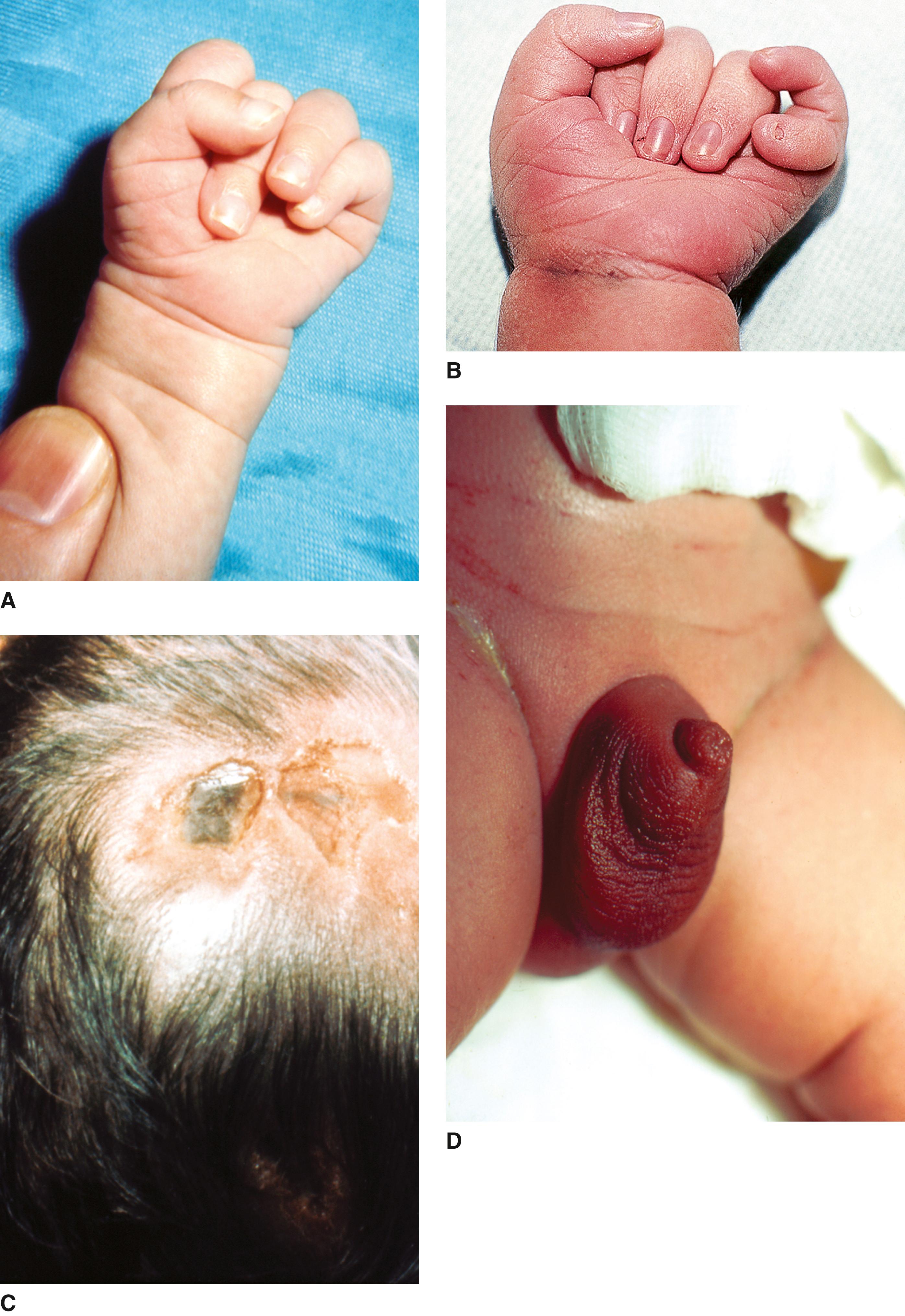 FIGURE 2, A and B, Note hyperconvex nails and postaxial polydactyly. C, Aplasia cutis congenita over posterior occiput. D, Scrotalization of the phallus.