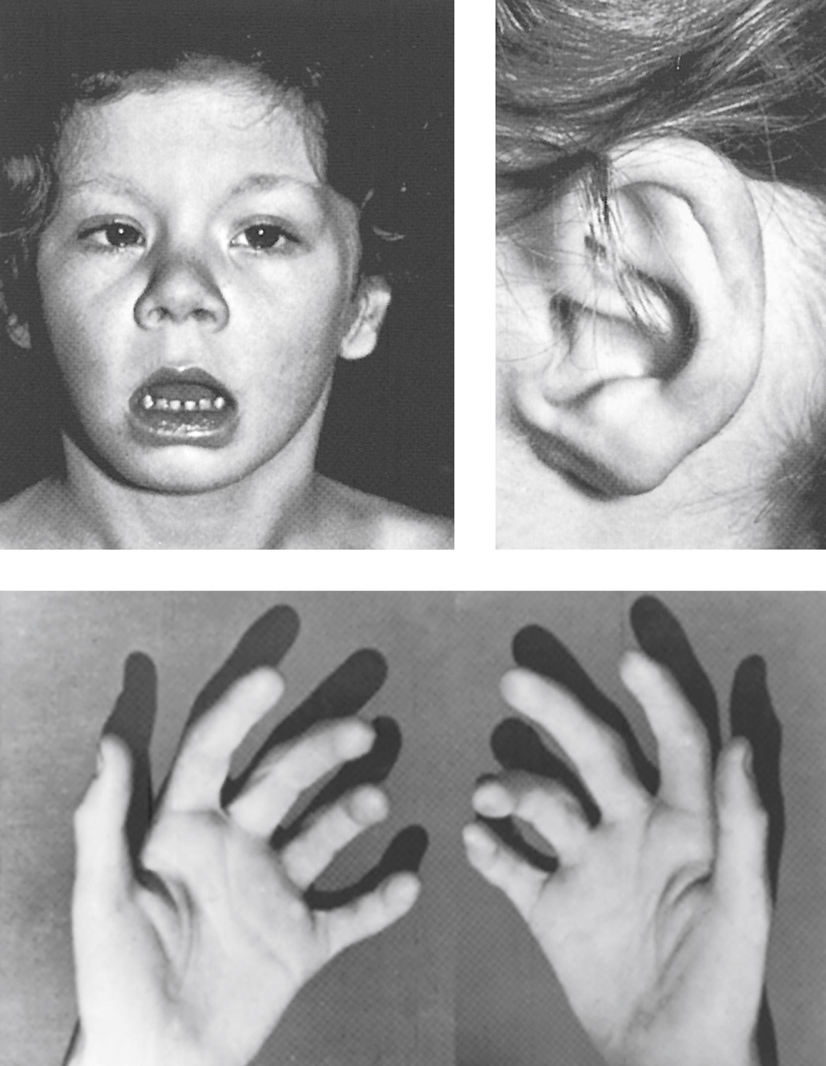 FIGURE 2, Boy with trisomy 8/normal mosaicism.