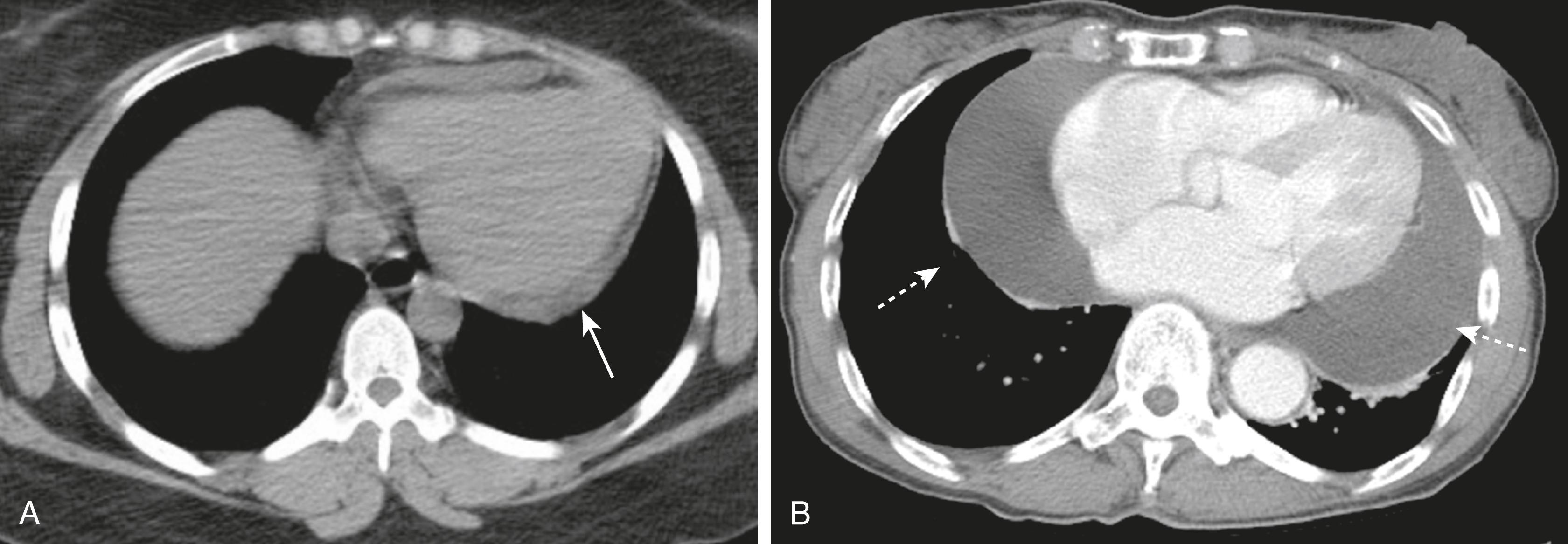 Fig. 11.1, Pericardial Effusions, Small and Large.