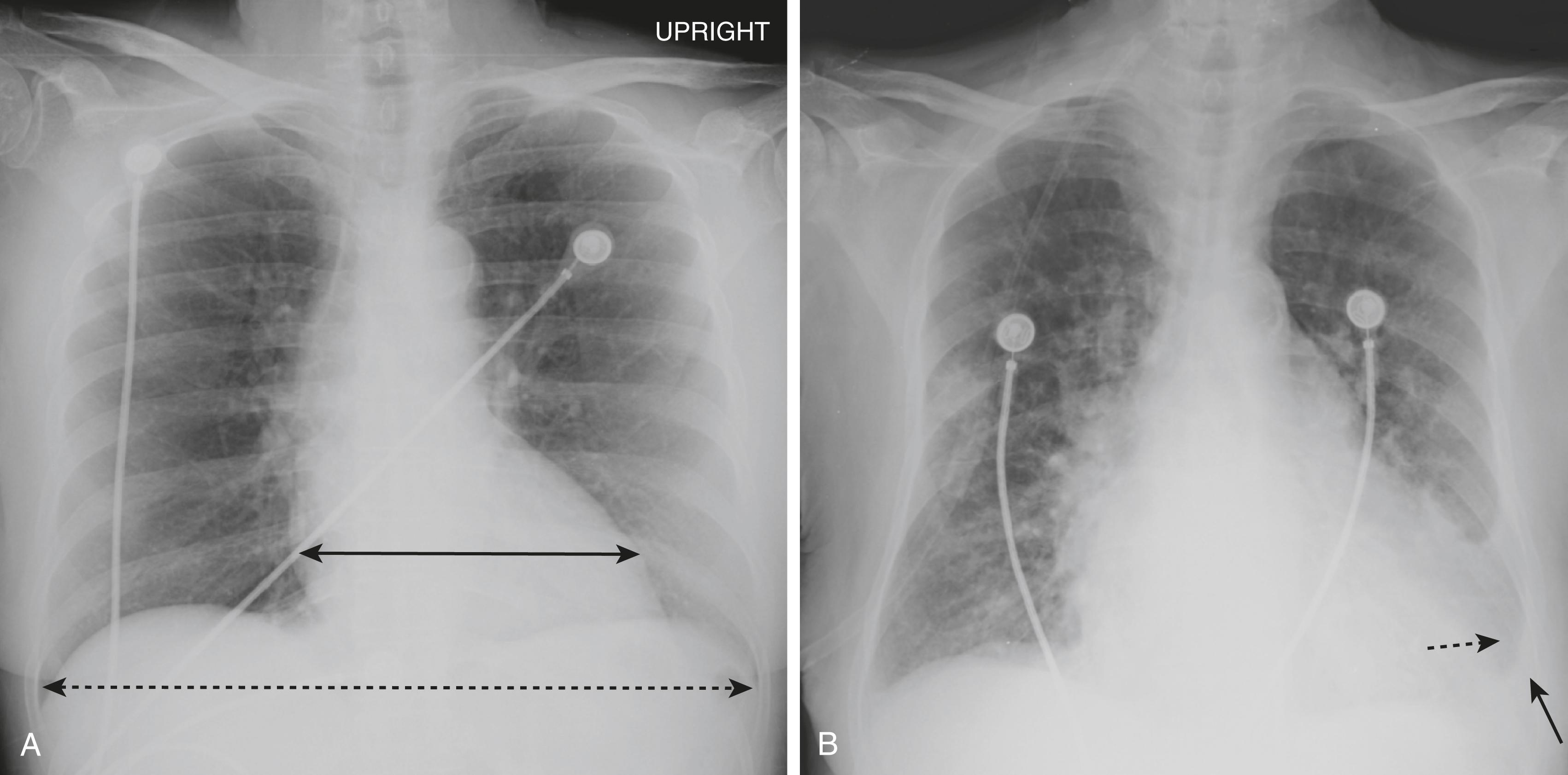 Fig. 11.2, Cardiomegaly on a Portable Radiograph.