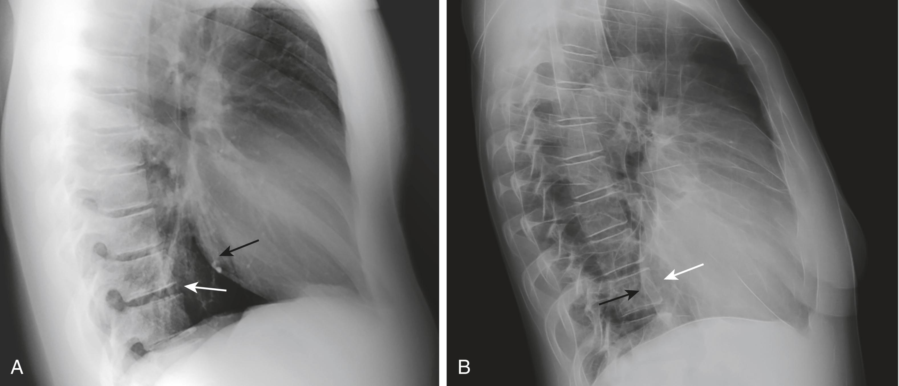 Fig. 11.3, Normal and Enlarged Appearance of the Cardiac Silhouette in the Lateral Projection.