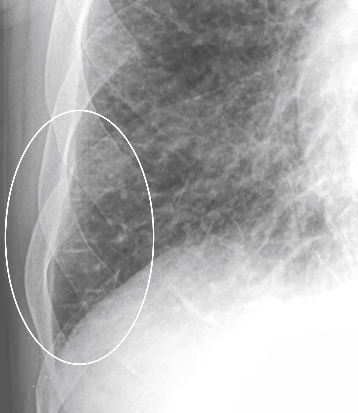 Fig. 11.4, Kerley B Lines.