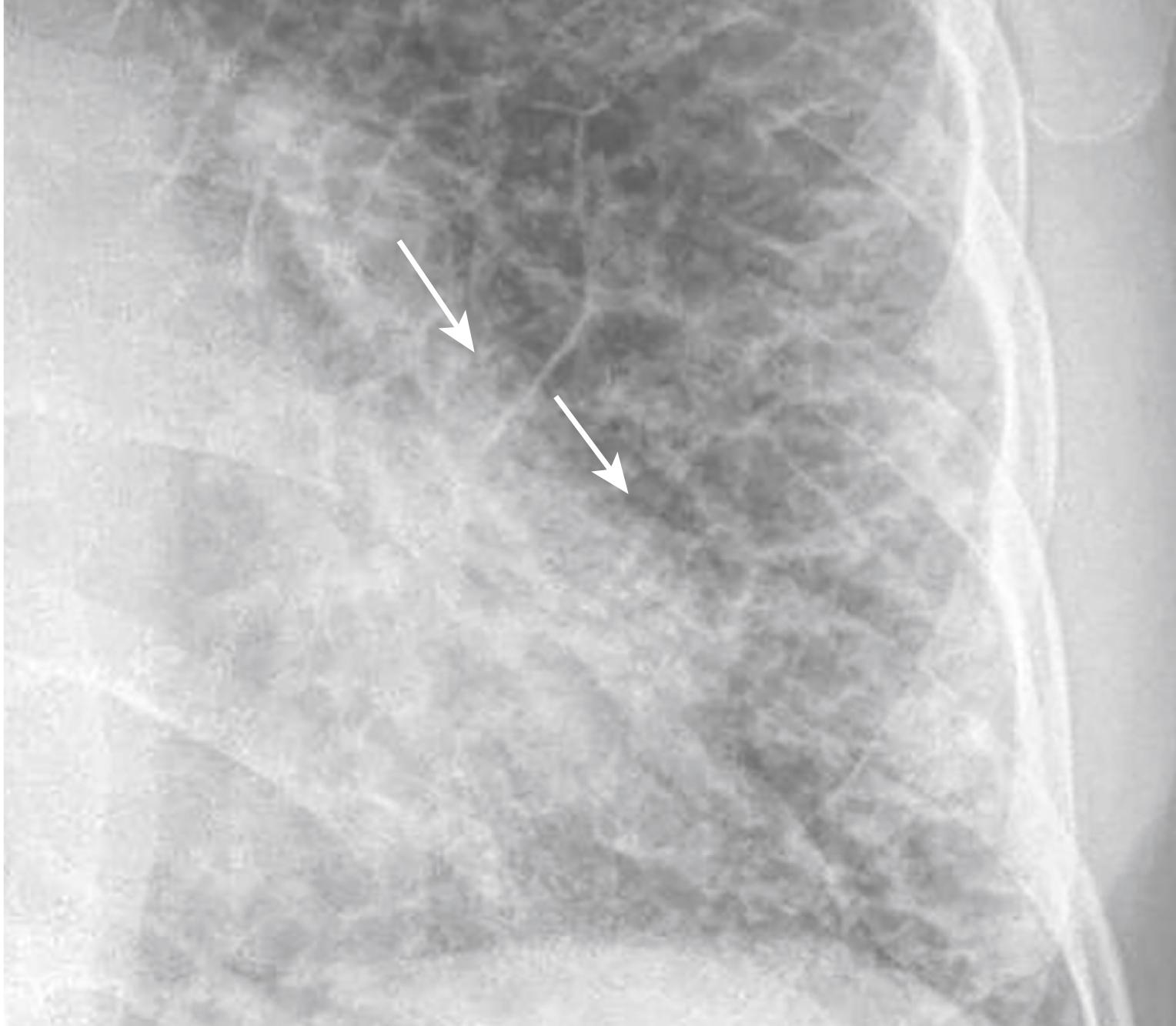 Fig. 11.5, Kerley A Lines.