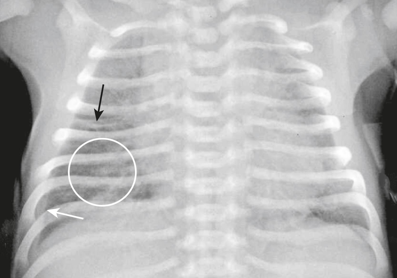 Fig. 27.1, Transient Tachypnea of the Newborn (TTN).