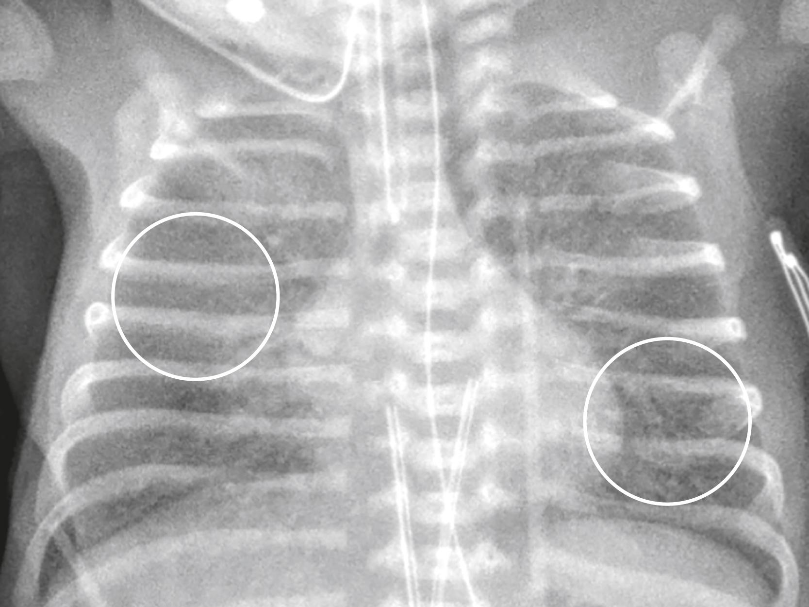 Fig. 27.2, Neonatal Respiratory Distress Syndrome (NRDS).