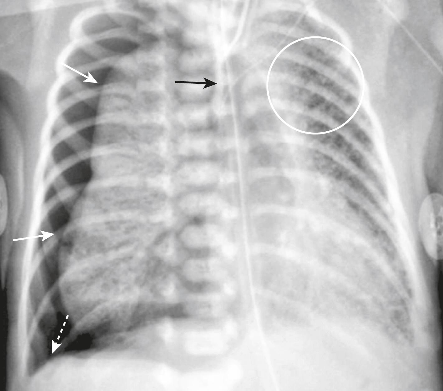 Fig. 27.4, Meconium Aspiration Syndrome with Pneumothorax.