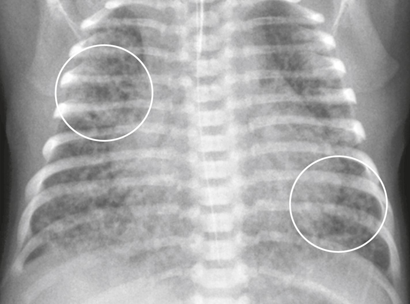 Fig. 27.3, Meconium Aspiration Syndrome.