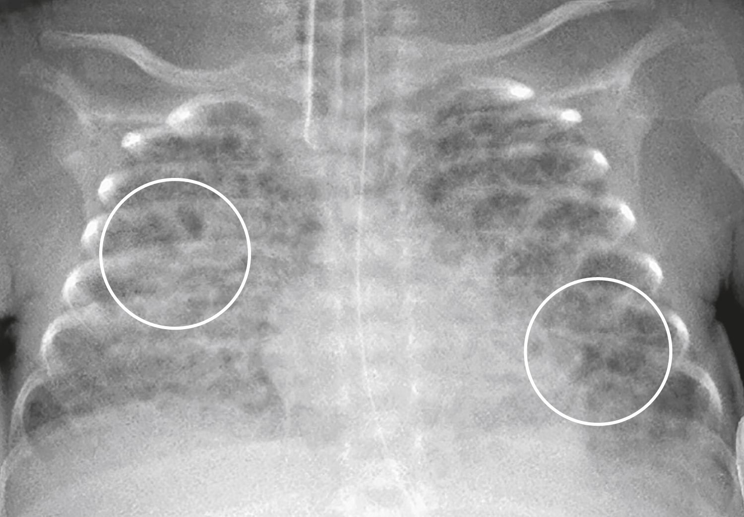 Fig. 27.5, Chronic Lung Disease of Infancy (CLD).