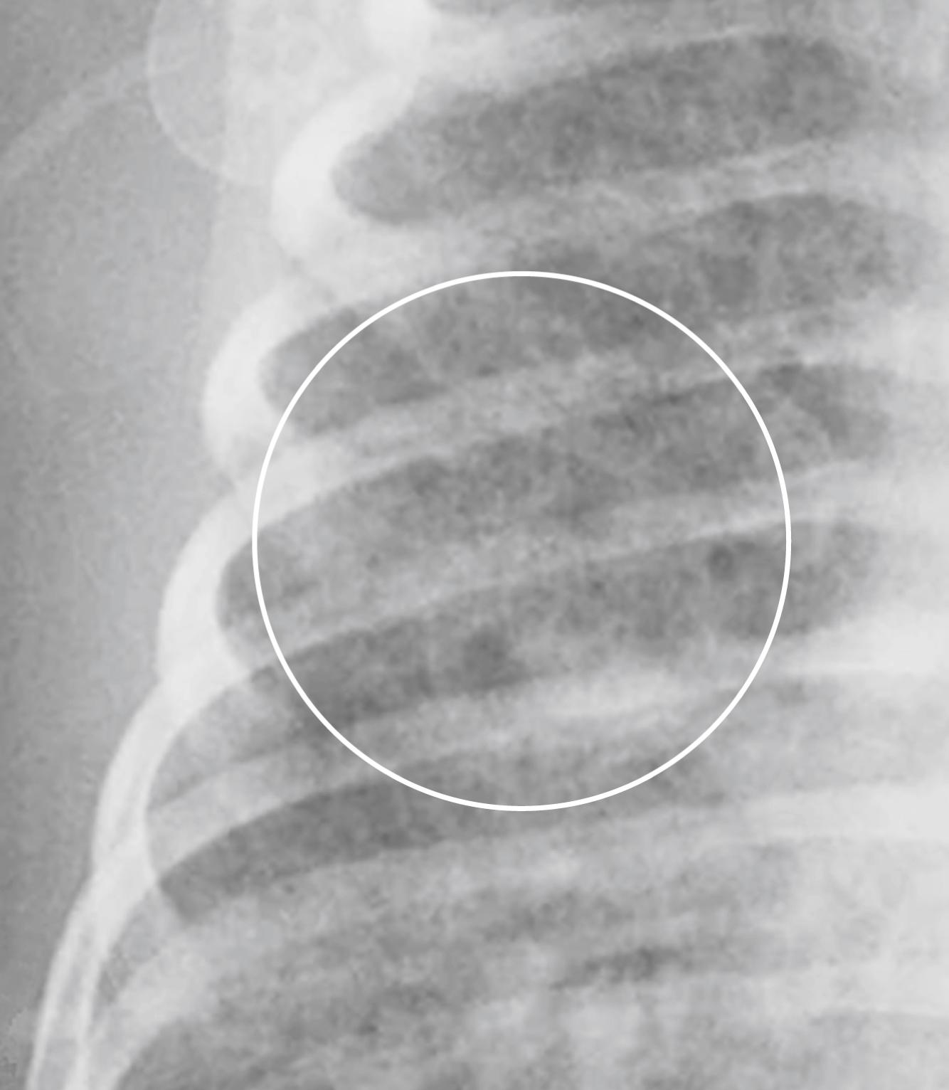 Fig. 27.6, Pulmonary Interstitial Emphysema.