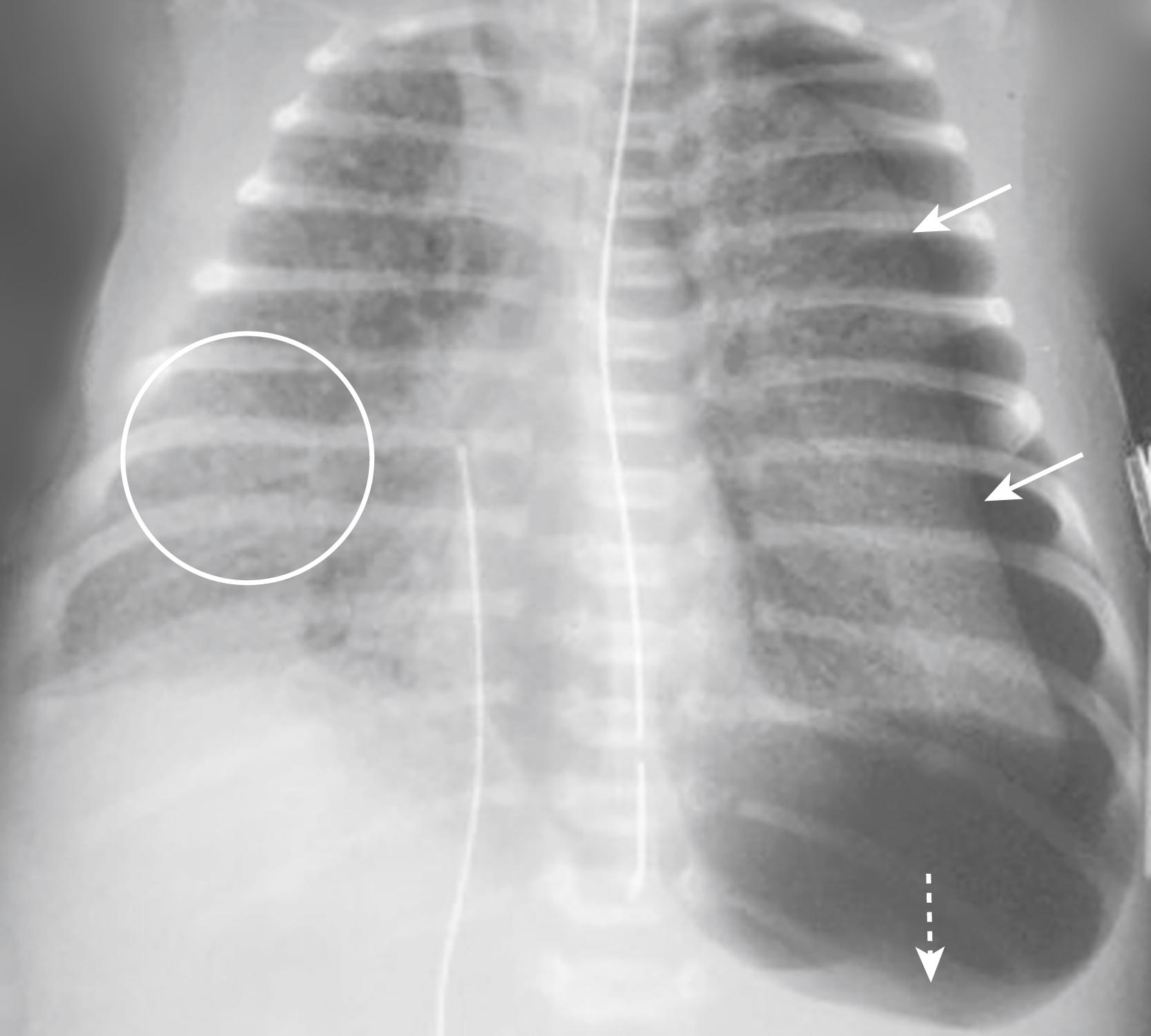 Fig. 27.7, Neonatal Respiratory Distress Syndrome with Pneumothorax.