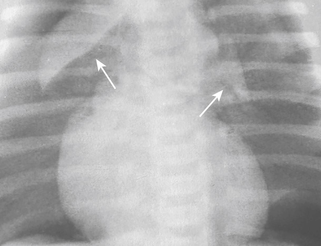 Fig. 27.8, Spinnaker Sail Sign from Pneumomediastinum.