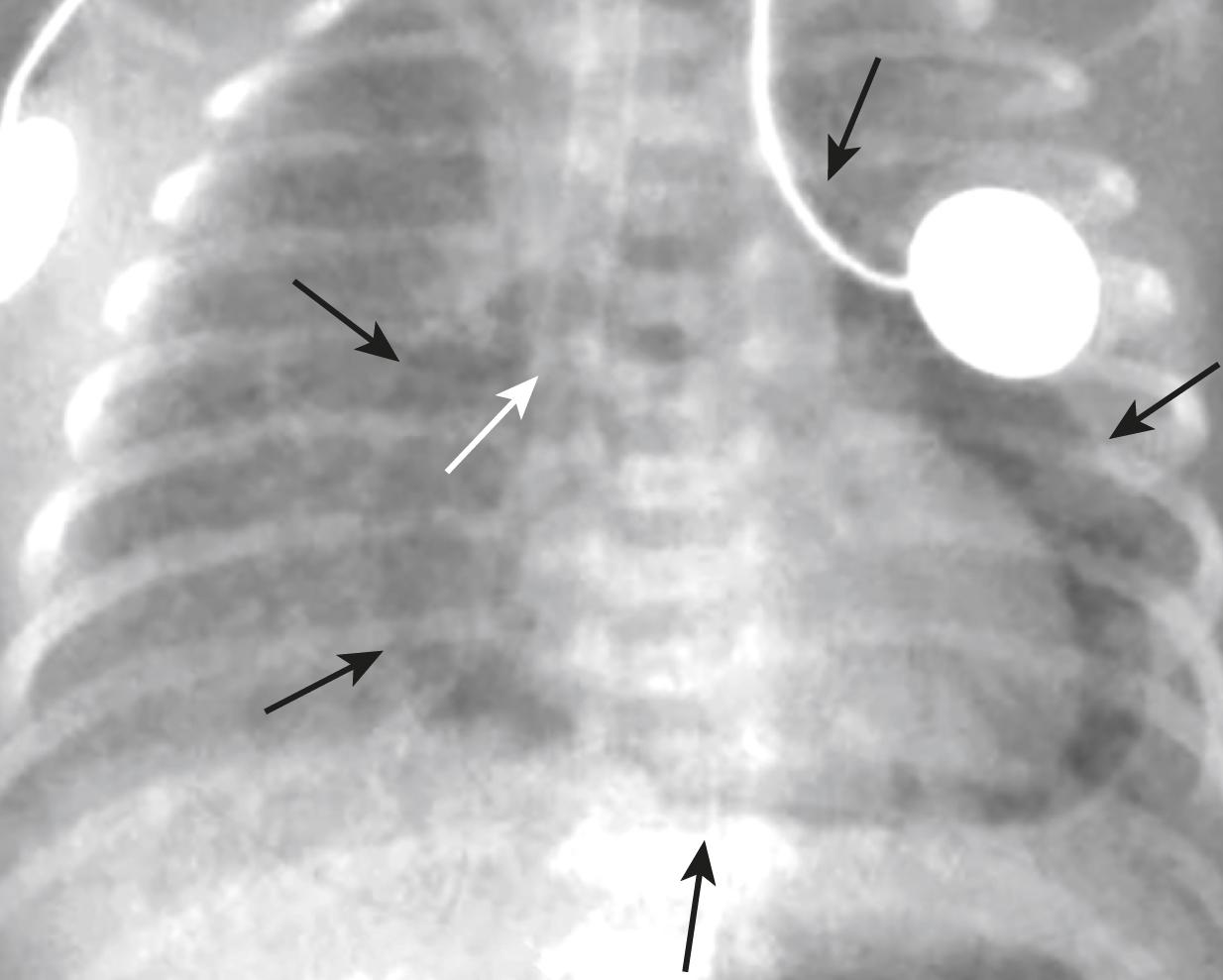 Fig. 27.9, Pneumopericardium.