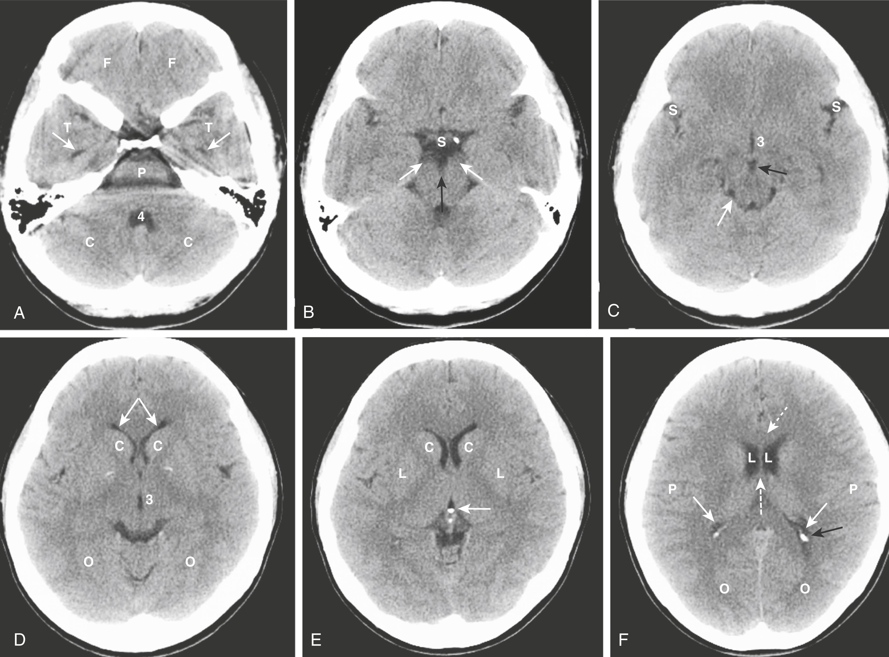 Fig. 26.1, Normal Unenhanced CT Scans of the Head.