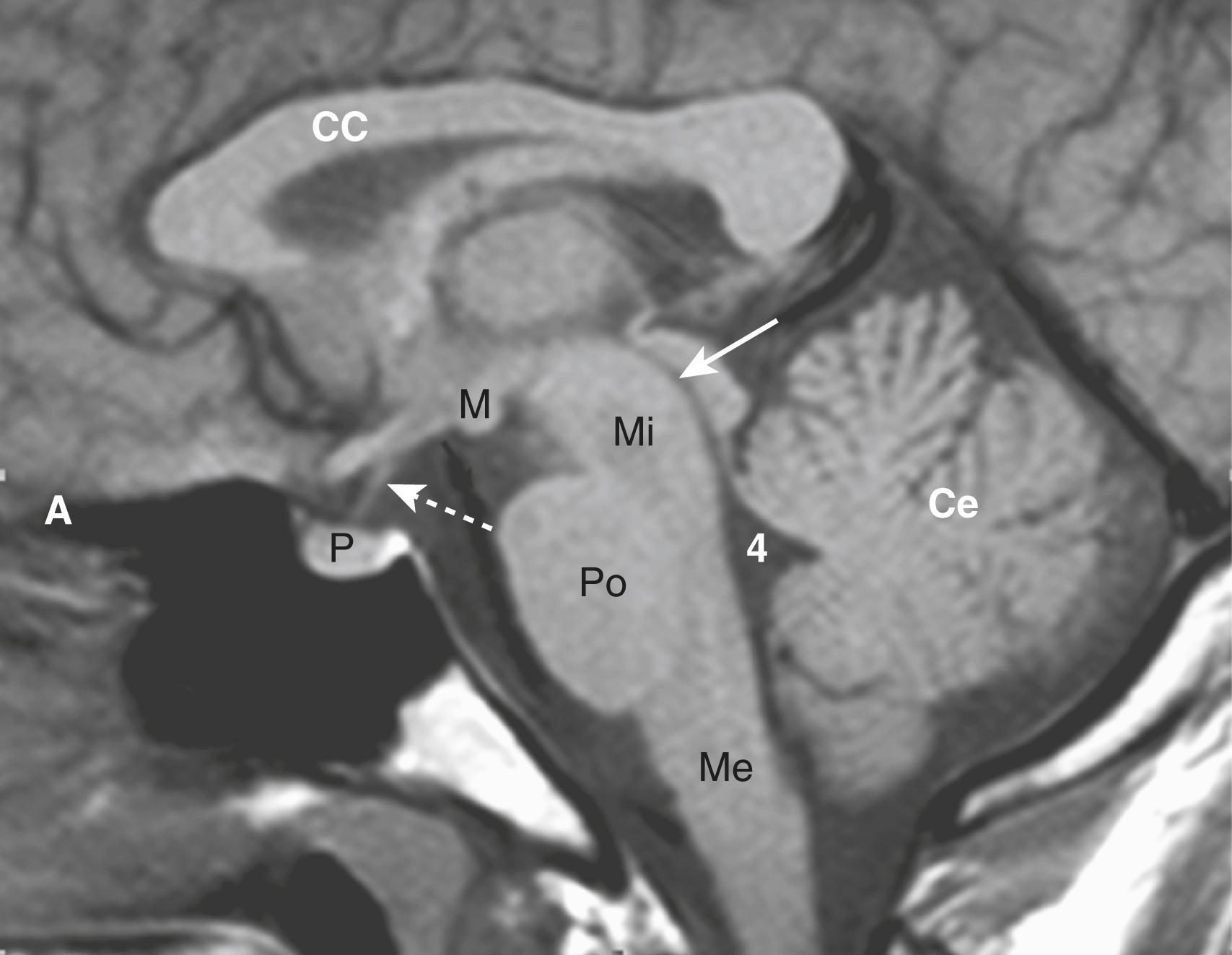 Fig. 26.3, Normal Midline MRI.