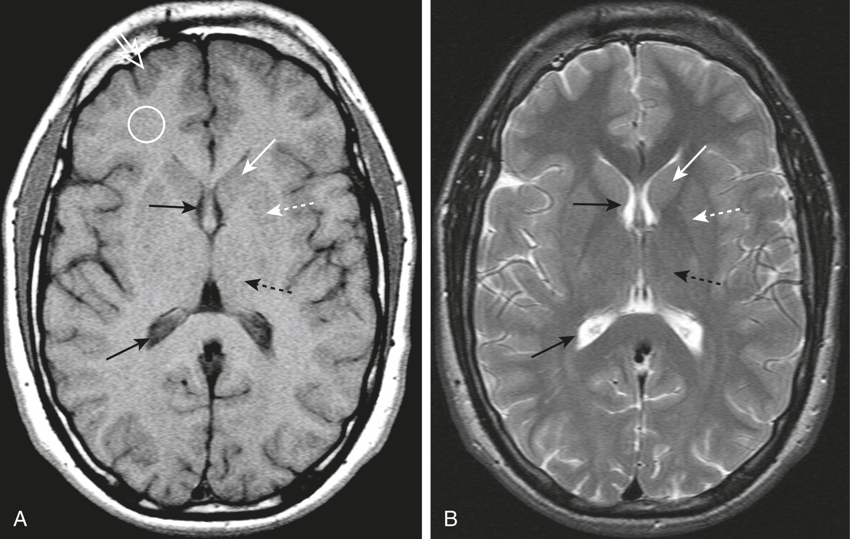 Fig. 26.4, Normal MRI of the Brain, T1 and T2.