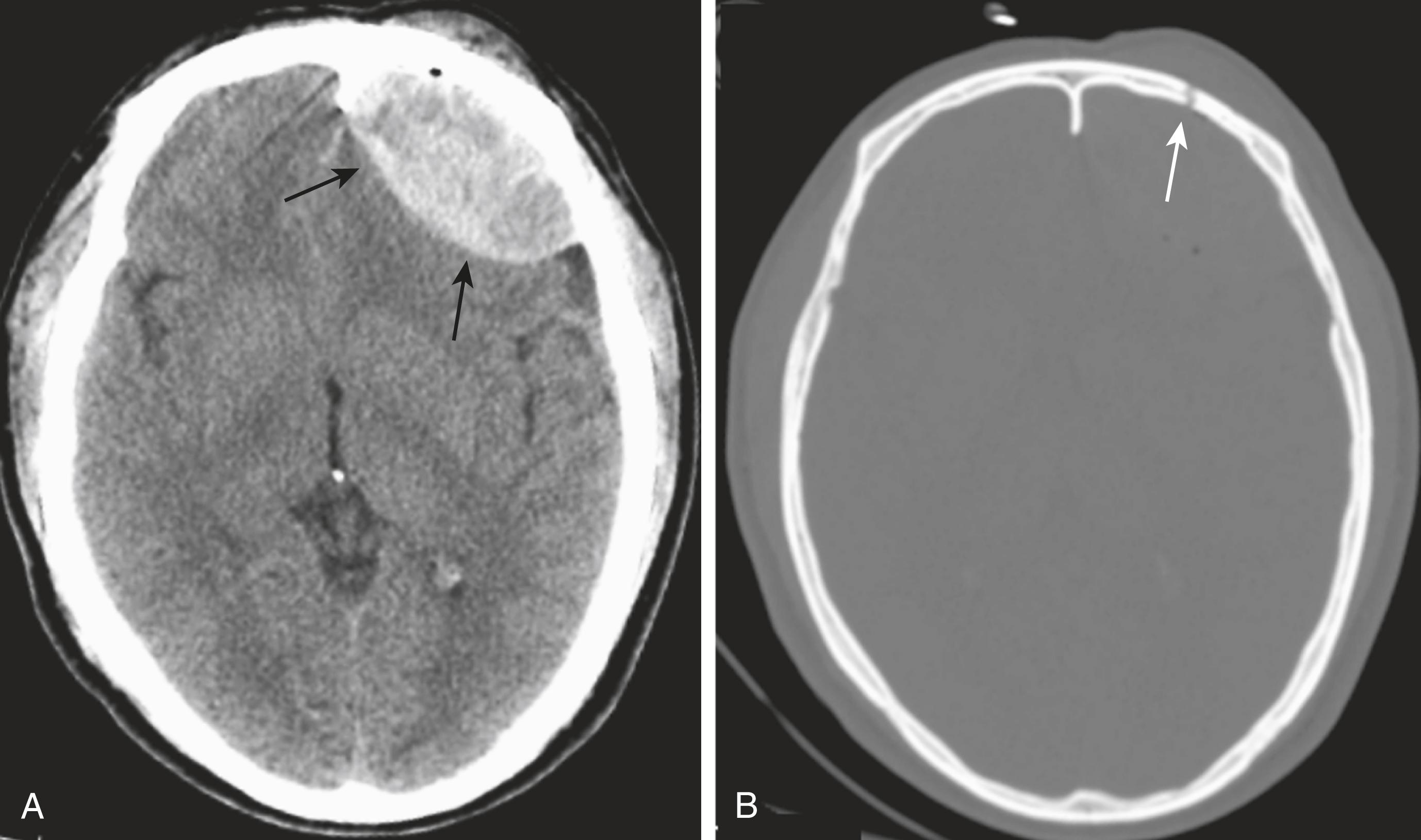 Fig. 26.5, Epidural Hematoma, Brain and Bone Windows.