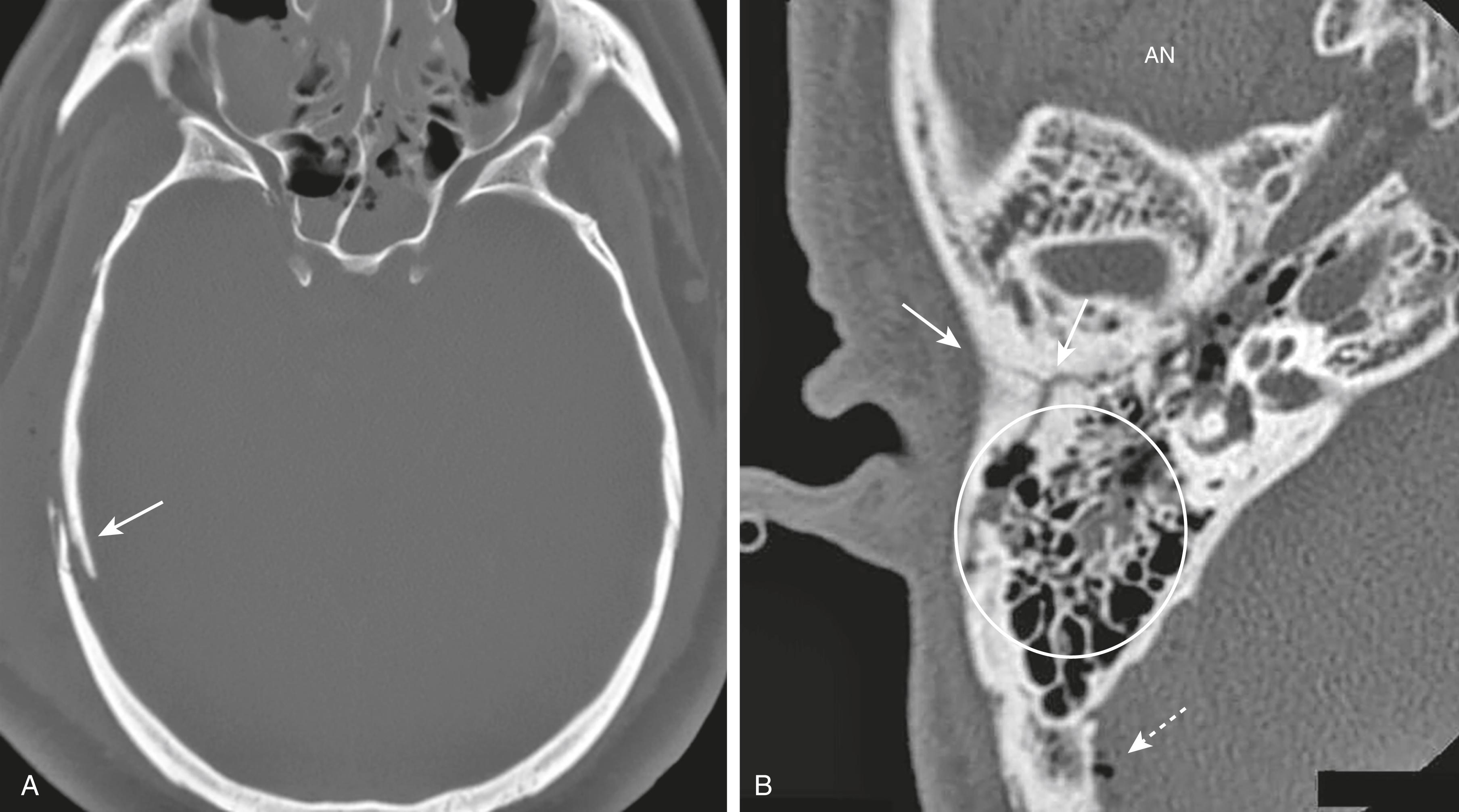 Fig. 26.6, Skull Fractures.