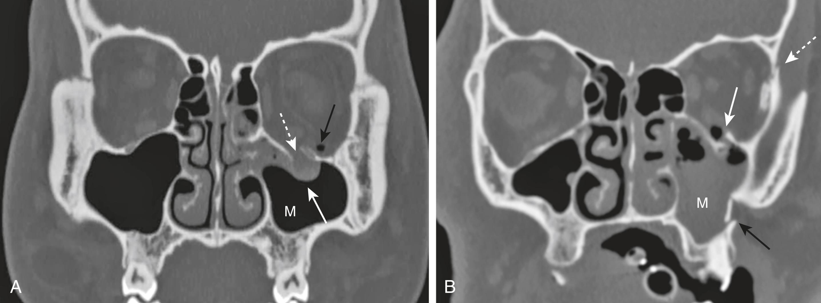 Fig. 26.7, Facial Bone Fractures.