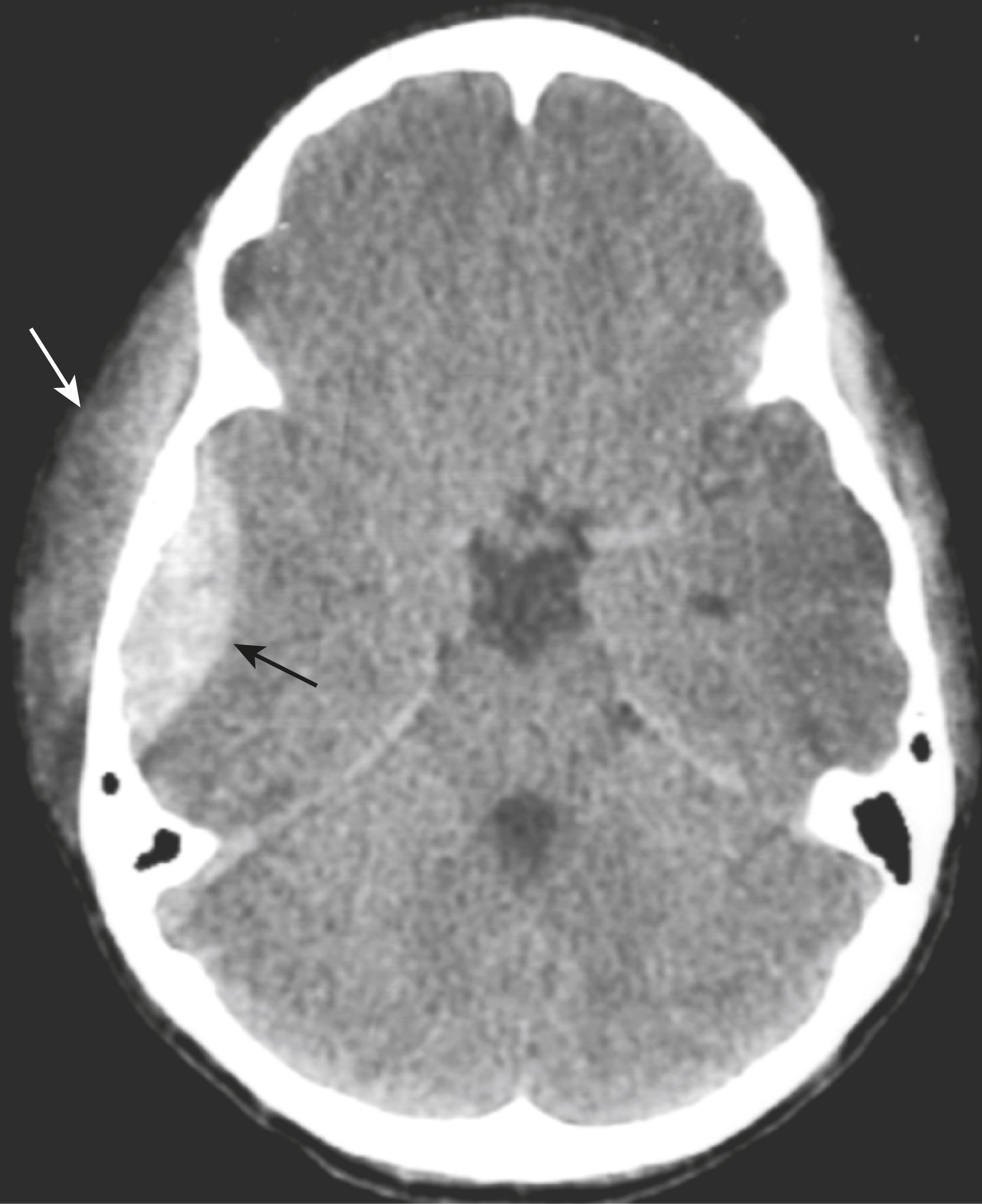 Fig. 26.9, Epidural Hematoma.