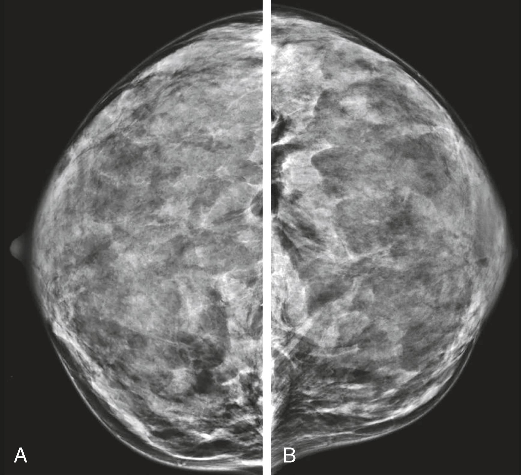 Fig. 29.1, Mammogram.