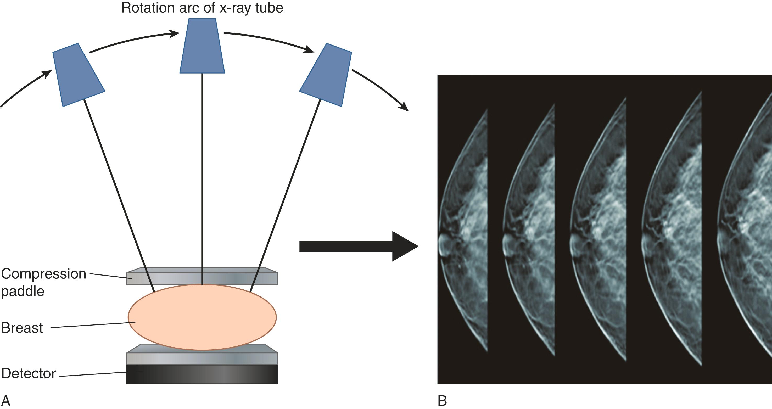 Fig. 29.2, Digital Breast Tomosynthesis.