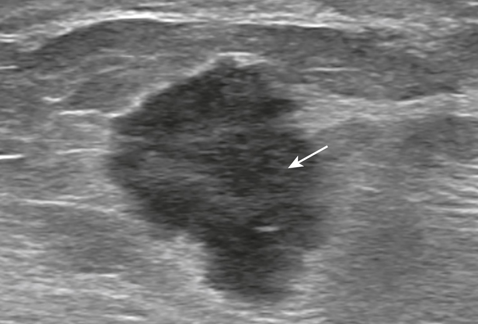 Fig. 29.4, Ultrasound of the Breast.