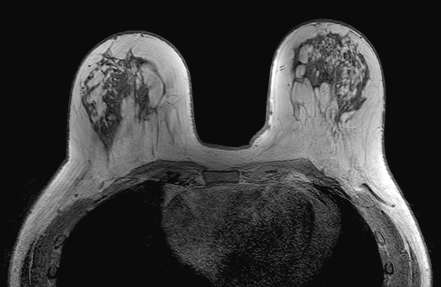 Fig. 29.5, Breast MRI.