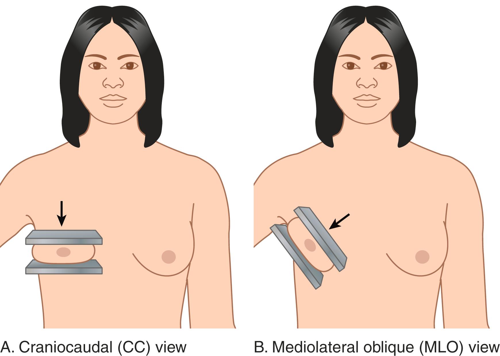 Fig. 29.6, Routine Views for Screening Mammography.