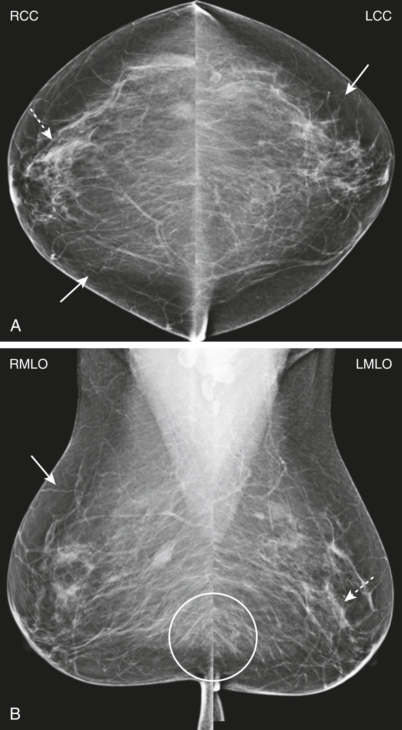 Fig. 29.7, Routine Mammographic Images.