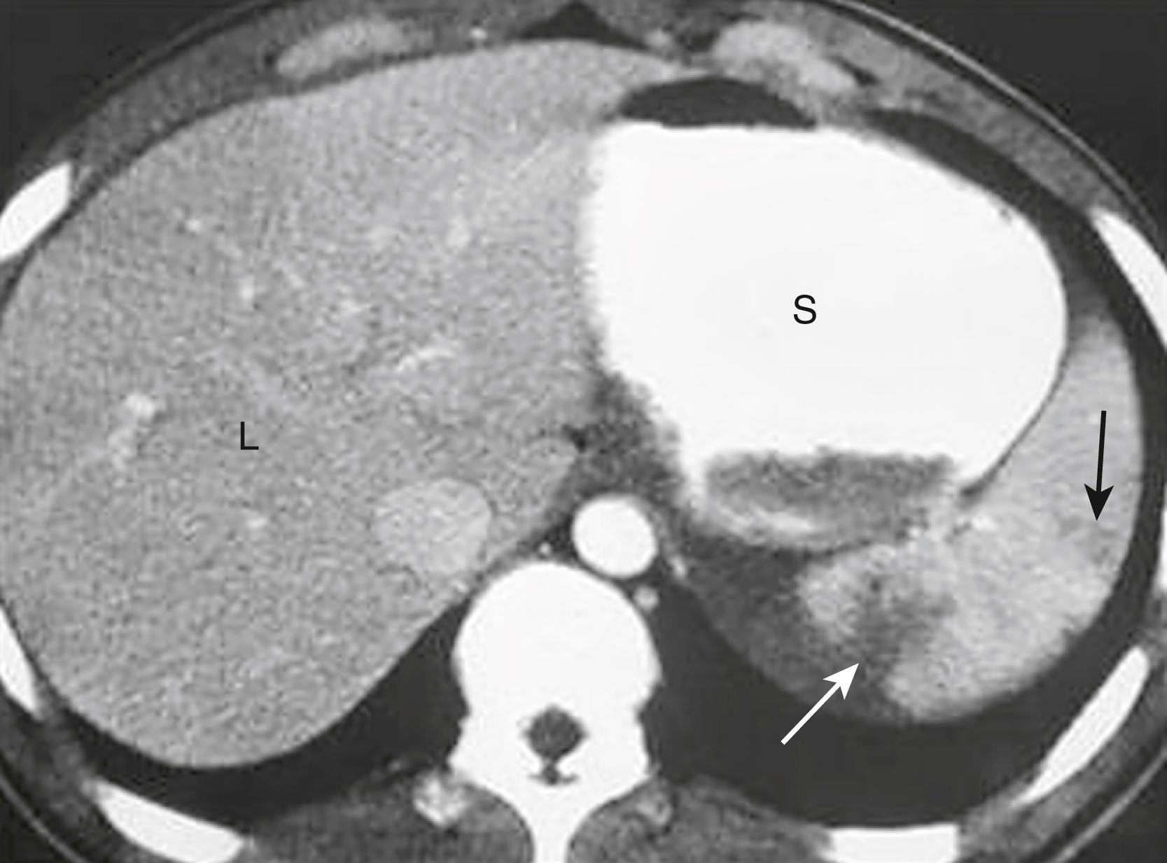 Fig. 25.3, Splenic Contusions.