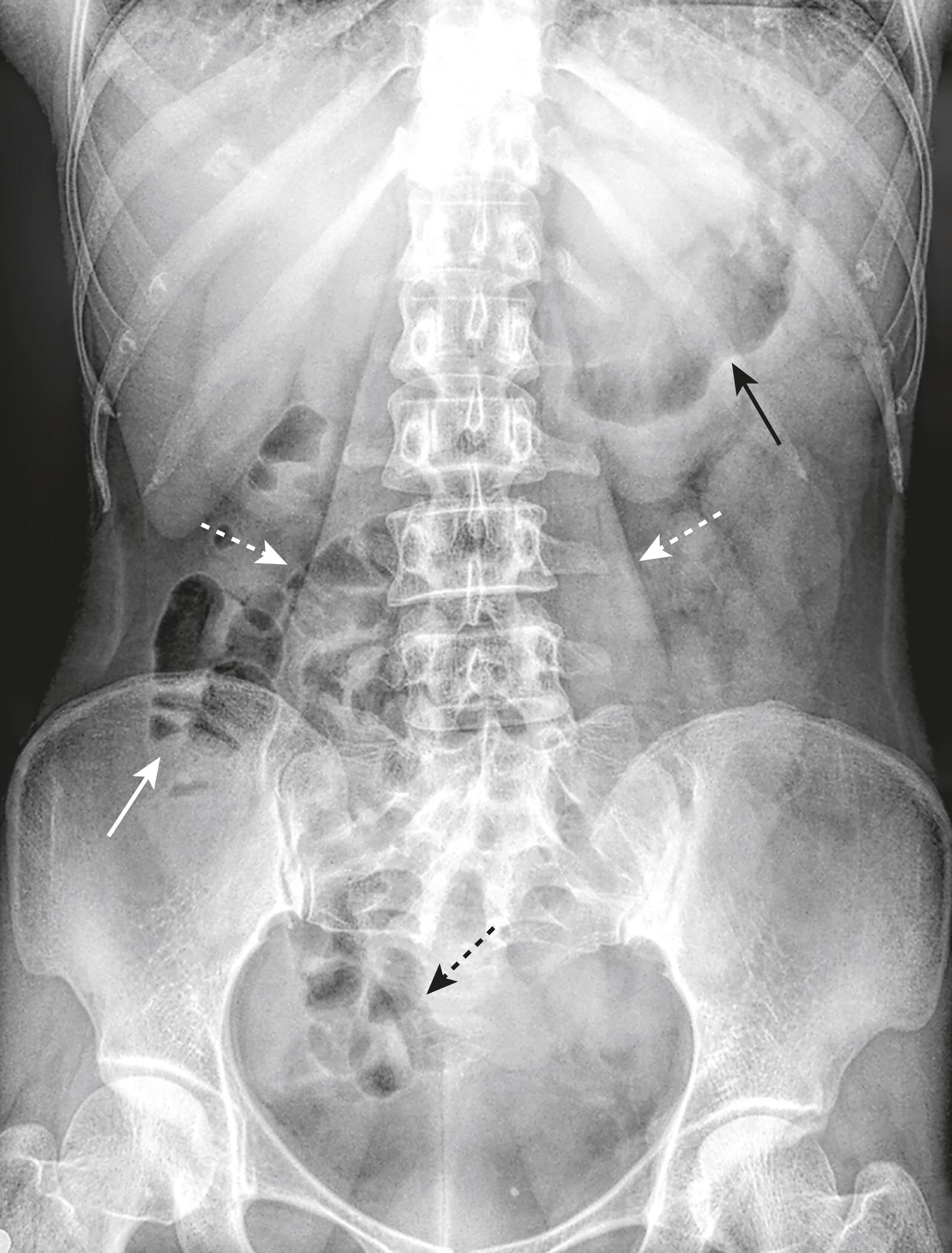 Fig. 12.1, Normal Supine Abdomen.