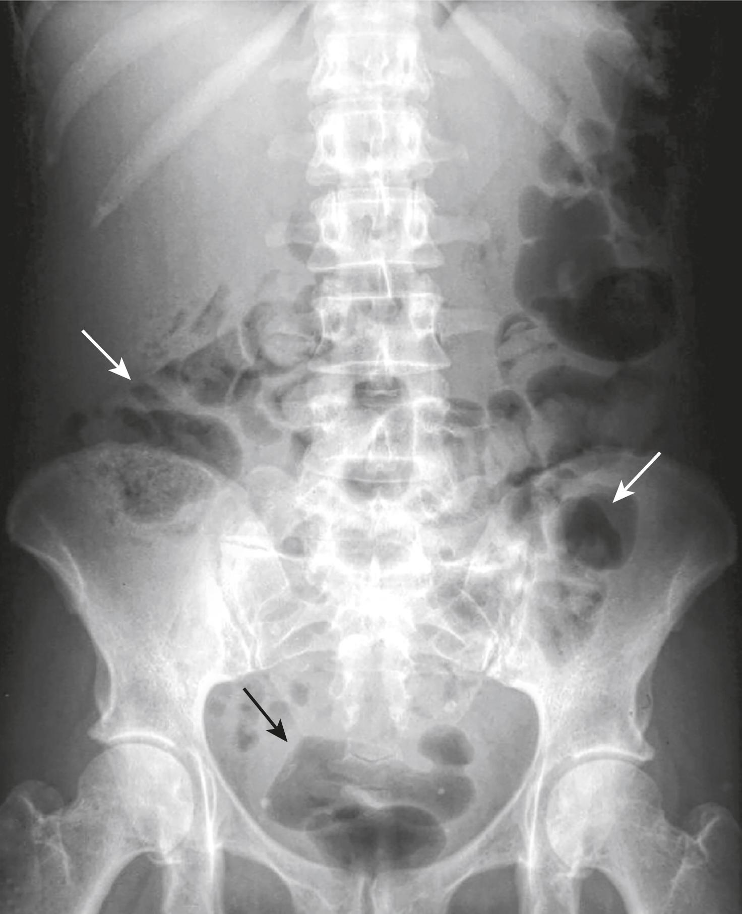 Fig. 12.2, Normal Prone Abdomen.