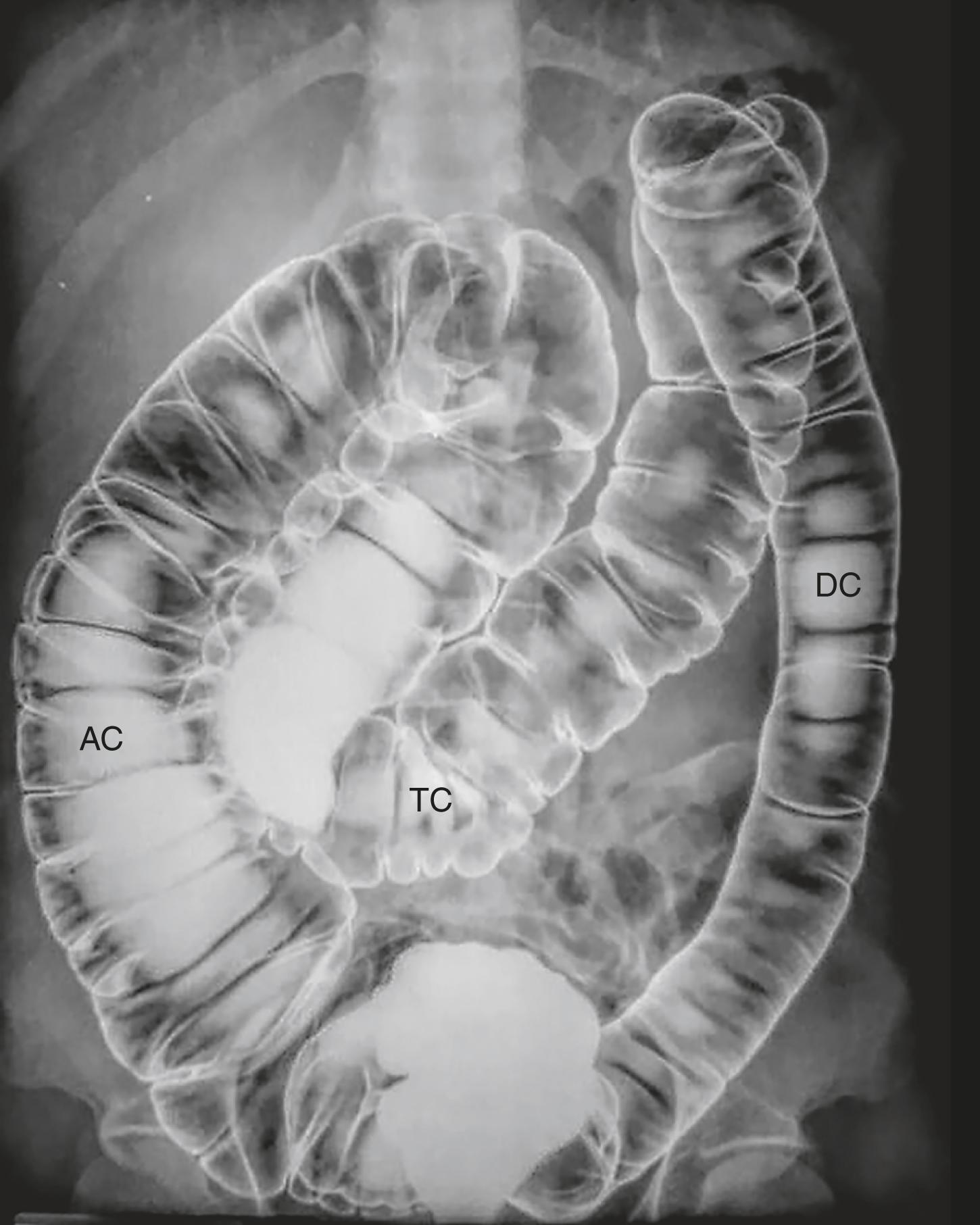 Fig. 12.3, Normal Colonic Distension.