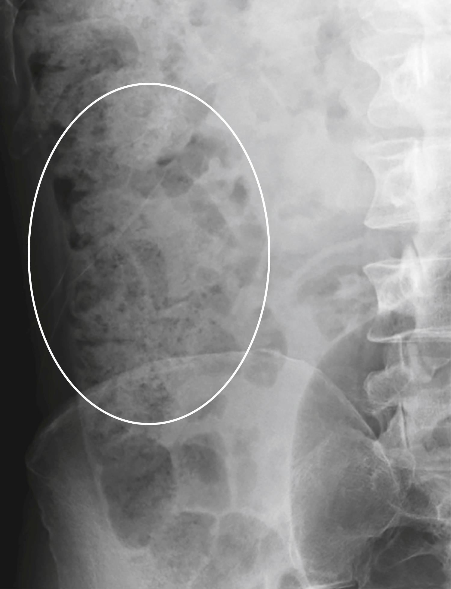 Fig. 12.4, Appearance of Stool.