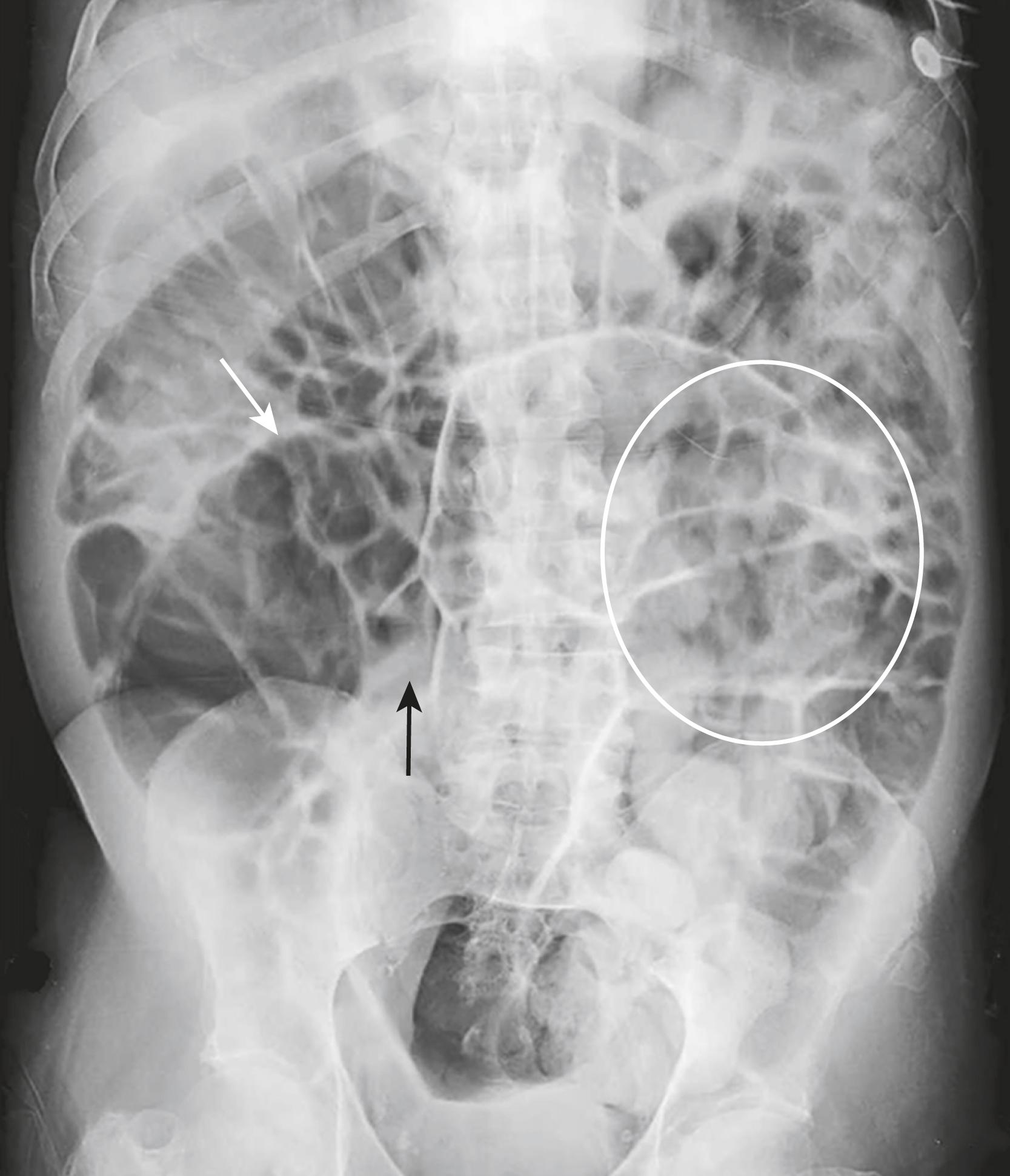 Fig. 12.5, Aerophagia.