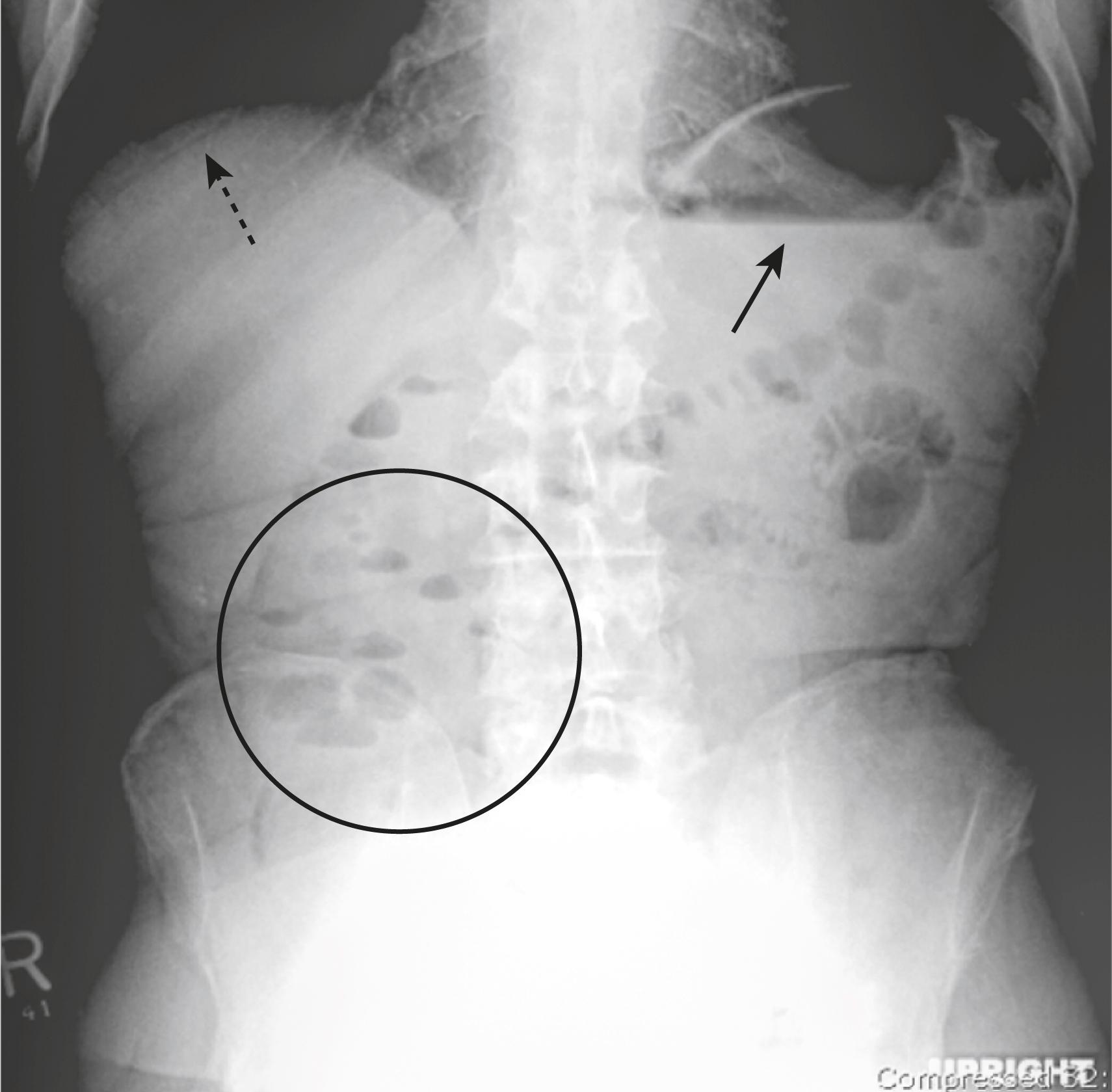 Fig. 12.6, Normal Air-Fluid Levels, Upright Abdomen.