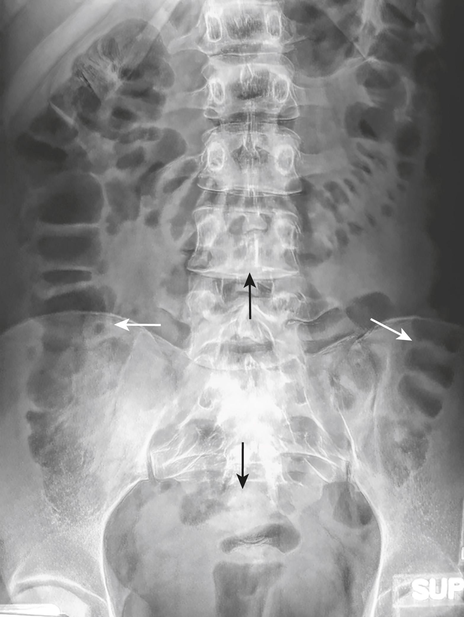 Fig. 12.7, Location of Large Bowel.