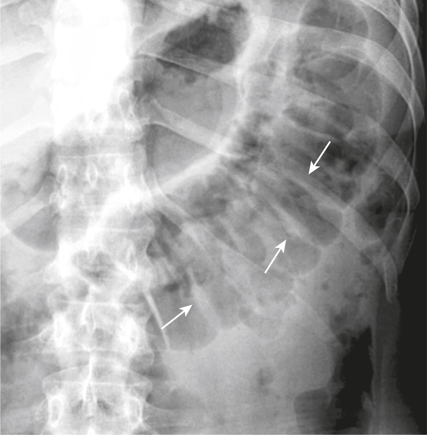 Fig. 12.8, Normal Large Bowel Haustral Markings.