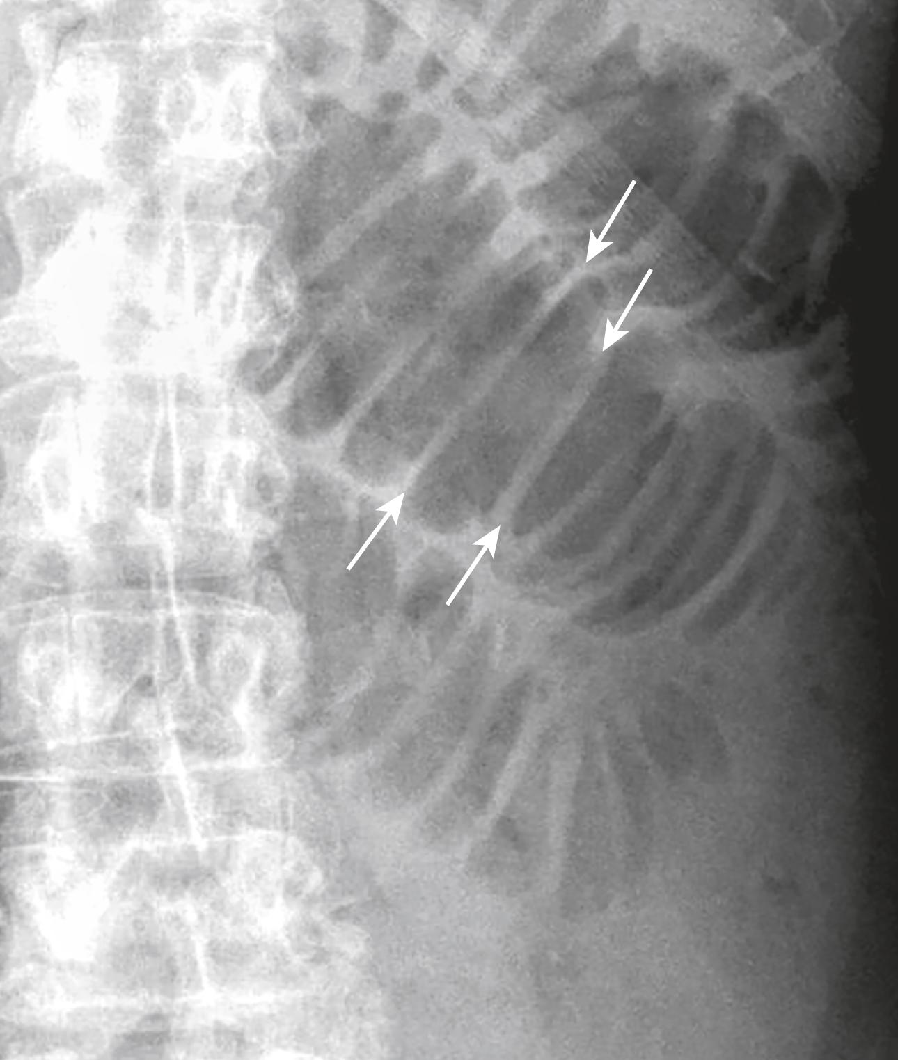 Fig. 12.9, Normal Small Bowel Valvulae.