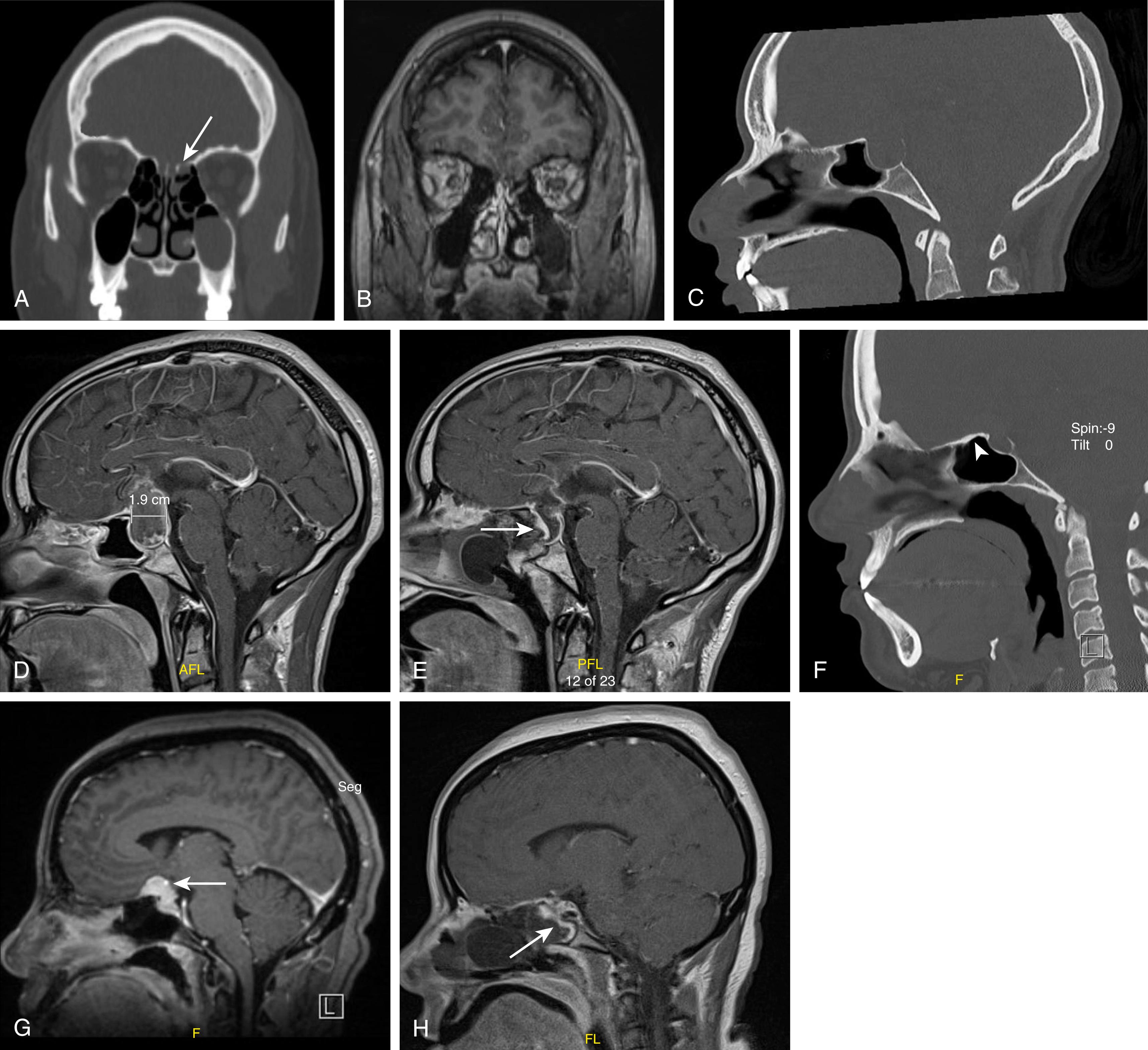 Fig. 124.1, Types of endonasal skull defects. Computed tomography (CT) demonstrates bony anatomy and allows planning of the approach corridor and sizing of the craniectomy defect for reconstruction. Magnetic resonance imaging (MRI) provides superior visualization of intracranial extent of disease and the relationship of neurovascular structures relative to the planned endoscopic corridor. A, Coronal CT (bone window) of a small encephalocele of the left ethmoid (arrow) with pooling of the cerebrospinal fluid in sinus cavities on the ipsilateral side. B, Coronal T1 contrasted MRI of a small encephalocele of the left ethmoid in the same patient as Fig. 124.1A . C, Sagittal CT (bone window) of a patient with a large pituitary adenoma. Note the expanded sella and thinning of the dorsum sellae (superior clivus). D, Sagittal T1 contrasted MRI of the same patient in 1C. Note the suprasellar extent and posterior expansion of the tumor. E, Immediate postoperative sagittal T1 contrasted MRI of the patient in 1C and 1D. Note the gross total resection of the tumor and the good placement and vascularity of the nasoseptal flap reconstruction at the arrow. A Foley balloon catheter is in place. F, Sagittal CT (bone window) of a patient with a tuberculum and planar meningioma. Note the tumor-related hyperostosis of the planum extending back to the tuberculum at the arrowhead. G, Sagittal T1 contrasted MRI of same patient in 1F. Note the tumor extending into the sella and the anterior communicating and A2 arteries running along the superior edge of the tumor but not fully encased in the tumor at the arrow. H, Immediate postoperative sagittal T1 contrasted MRI of the patient in 1F and 1G. Note the good placement and vascularity of the nasoseptal flap reconstruction at the arrow.