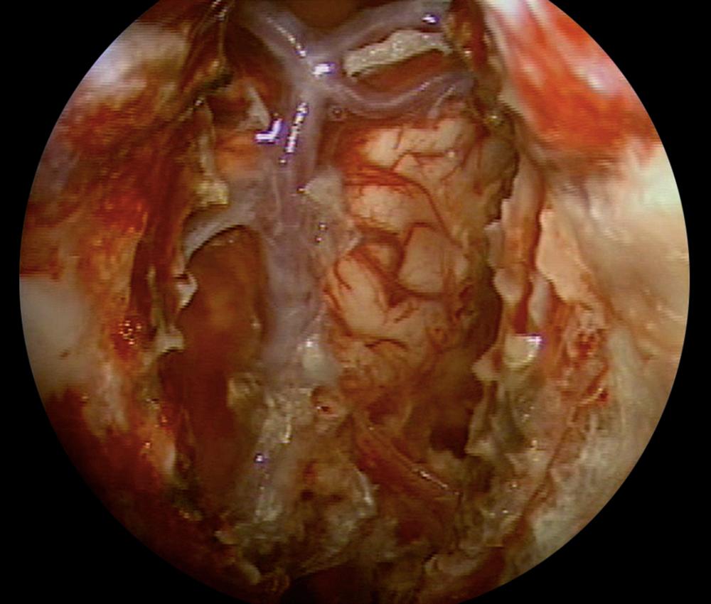 Fig. 124.2, Endoscopic view of a skull base defect from an endonasal approach following resection of a posterior fossa meningioma. The basilar artery and basilar tip can been seen through the transclival defect.