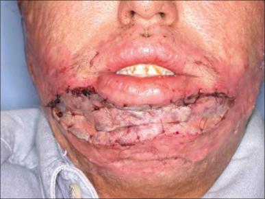 Fig. 49.7, A partial-thickness skin graft was used to cover an open wound resulting from releasing of a contracted lower lip.