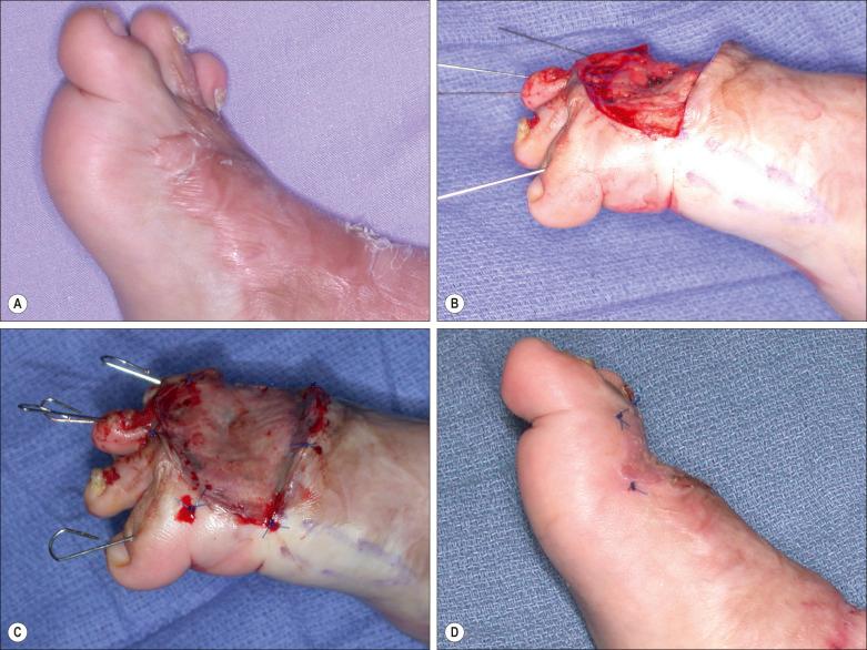 Fig. 56.1, In children with recent onset of toe extension contracture, surgical manipulation of the volar plate of the MTP joint capsule is usually unnecessary. (A) Cicatrical dorsal toe contracture creating a hammer toe like deformity. (B) A Kirschner's wire of 0.020–0.035 inch size is inserted through the proximal phalanx to keep the digit in full extension while maintaining the MTPJ in 45–60° plantar flexion. (C) Split-thickness skin graft is placed to fill the skin defect. (D) The wires are removed 10–14 days later, once the take of skin graft or flap is established.