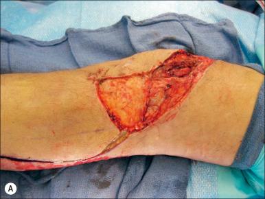 Fig. 56.2, (A) A full-thickness injury has exposed the lateral surface of the knee capsule. (B) The lateral gastrocnemius muscle is mobilized; the peroneal nerve is protected with vessel loop. (C) The muscle is set into the defect. (D) The muscle and overlying skin graft at 4 months.