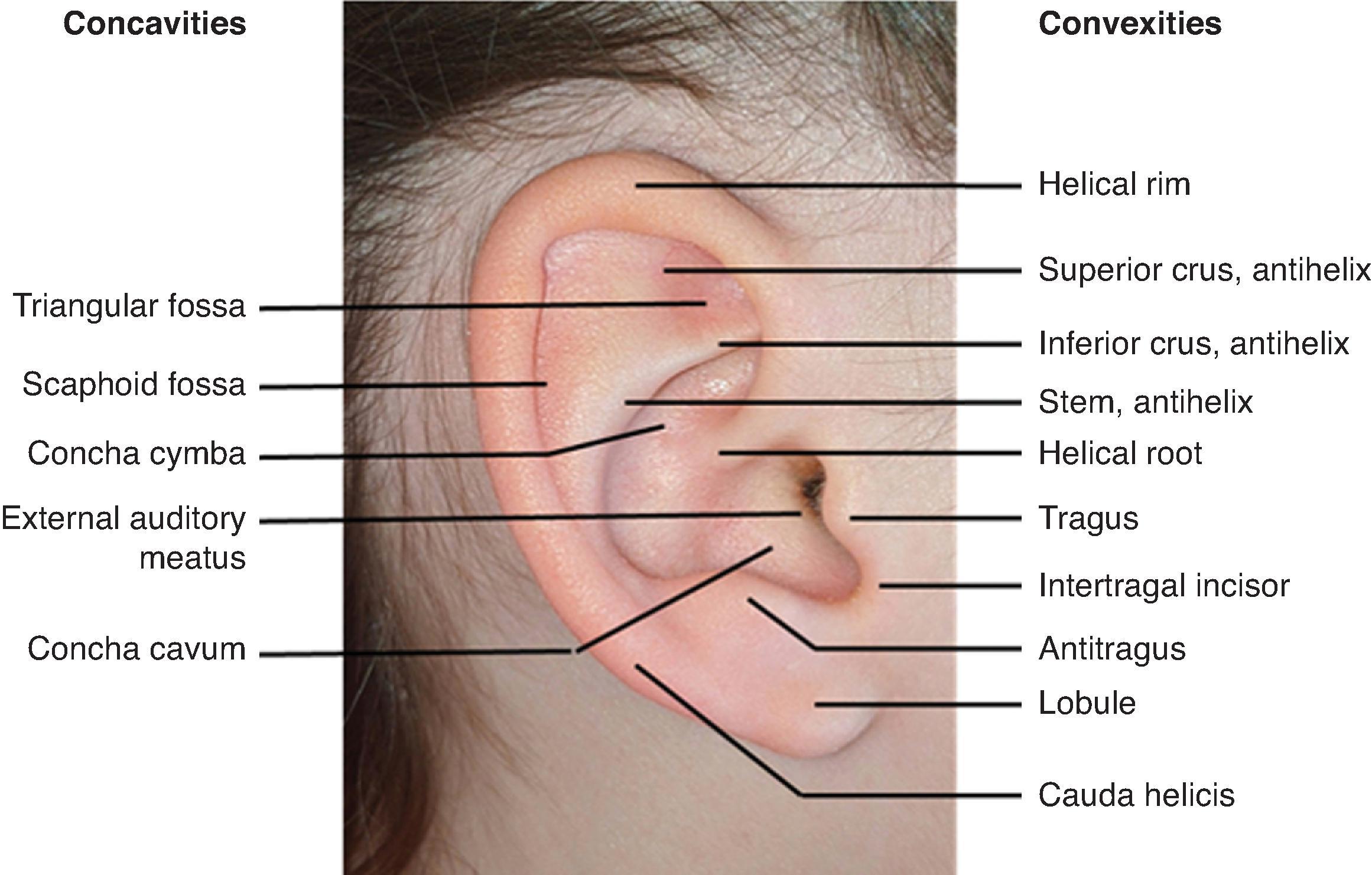 FIG. 23.2, Anatomic landmarks of the auricle grouped by concavities on the left and convexities on the right.